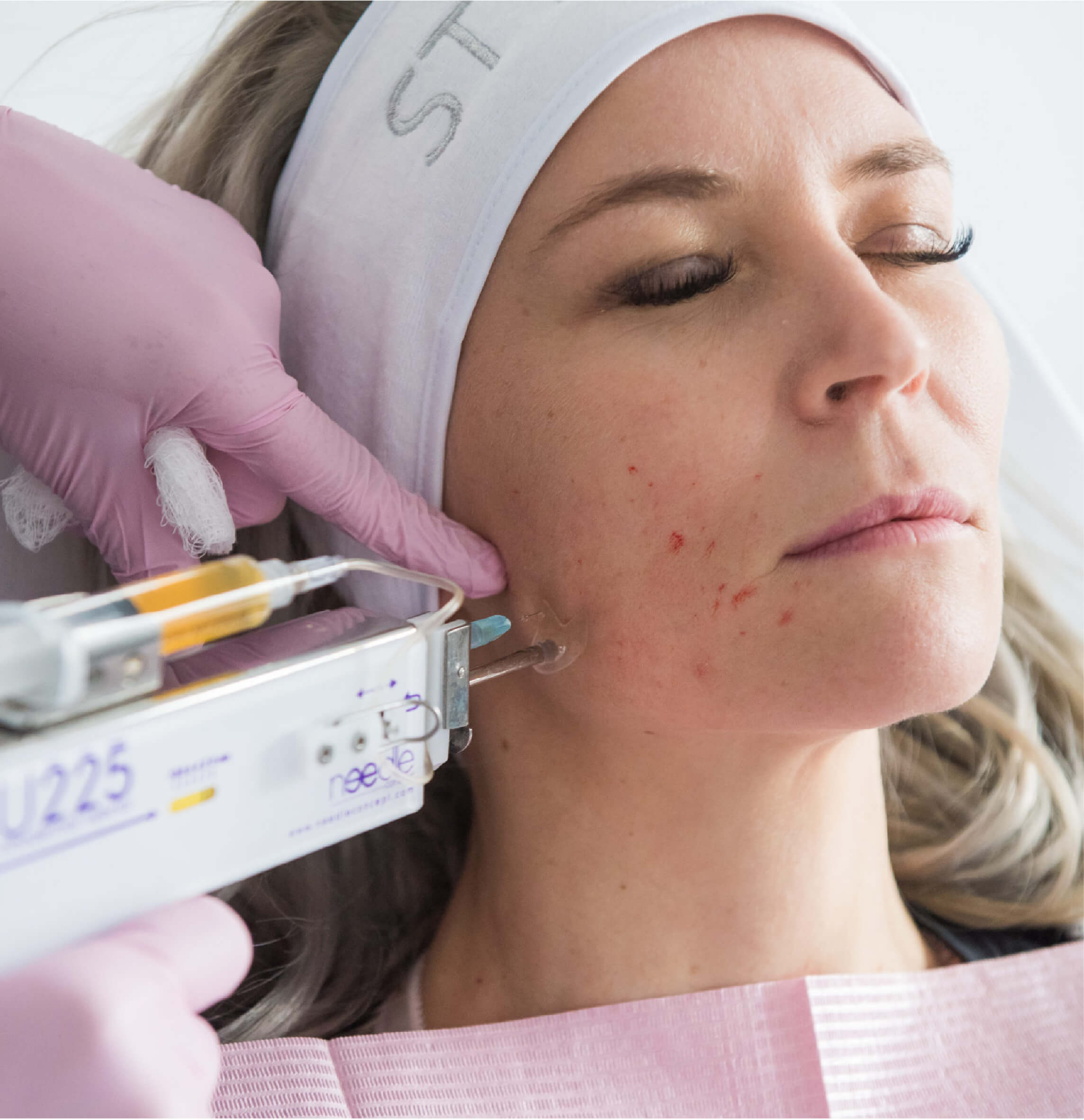 Traitement PRPGlow avec microneedling en cours, une méthode avancée combinant plasma riche en plaquettes et stimulation cutanée pour une peau plus éclatante et rajeunie