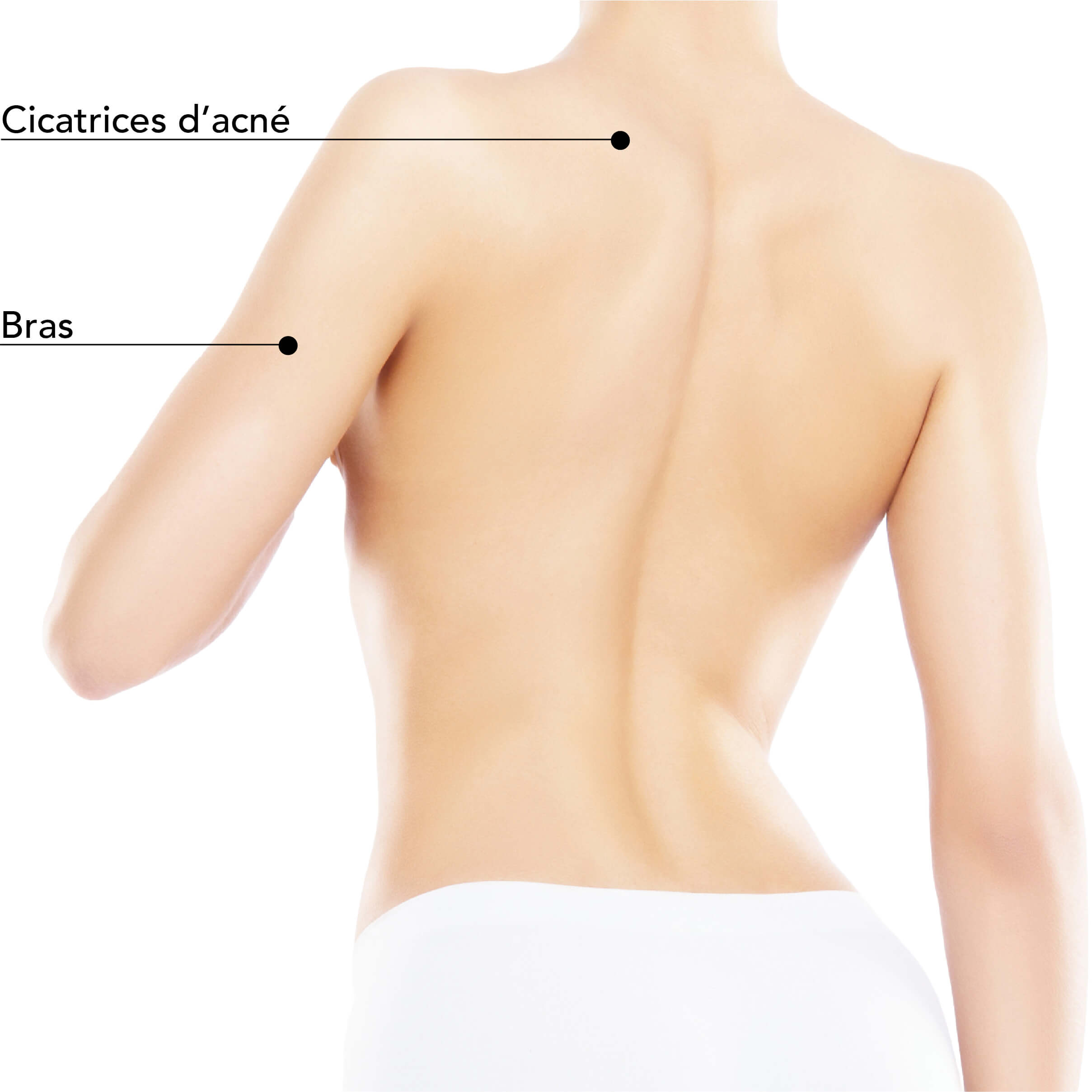 https://www.stlaurentme.com/wp-content/uploads/2024/05/St-Laurent-Medico-Esthetique_Microneedling-RF-Radio-Frequence_Zones_traitable_3.jpg