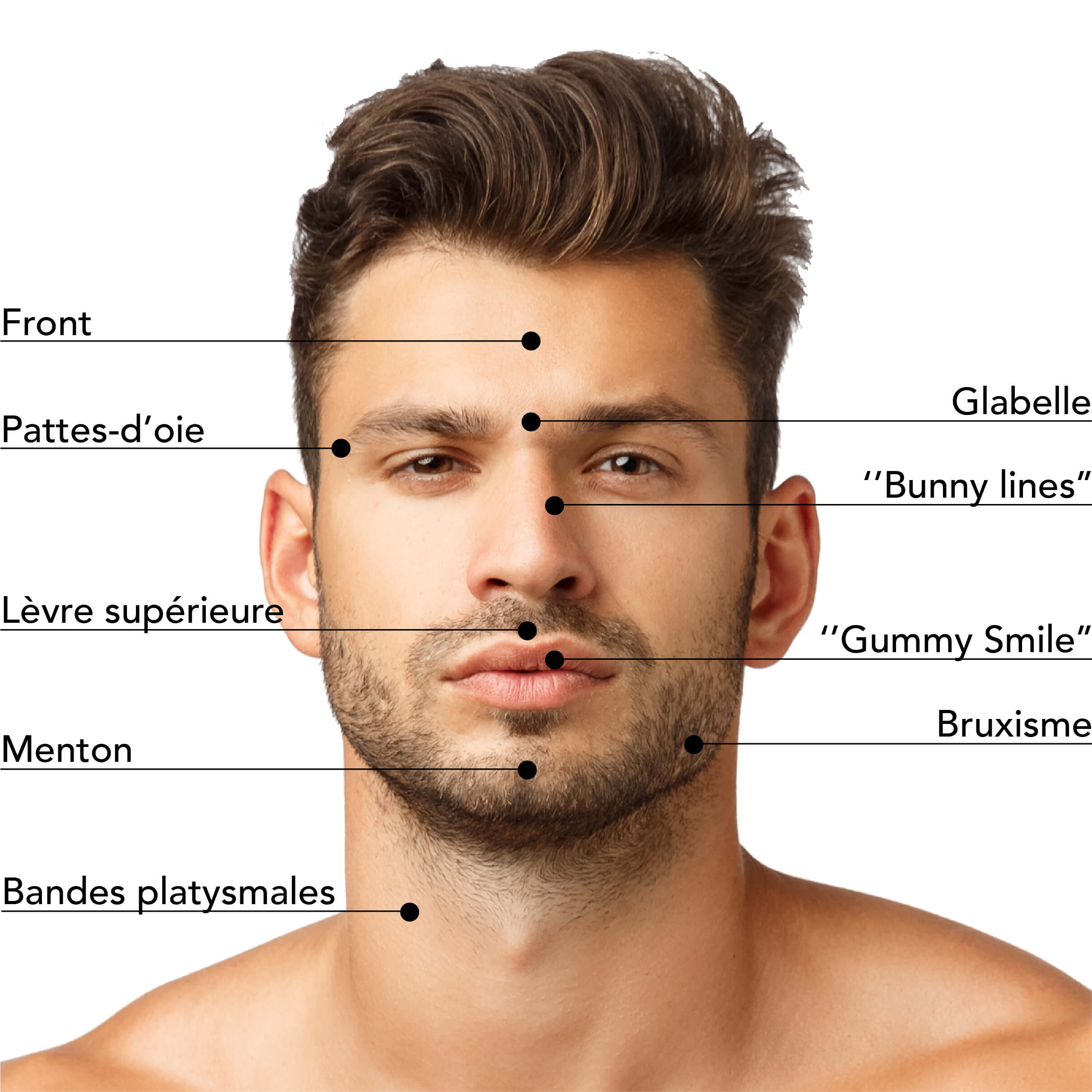 Zones du visage masculin traitées par les injections de Brotox : front, rides du lion, pattes d’oie