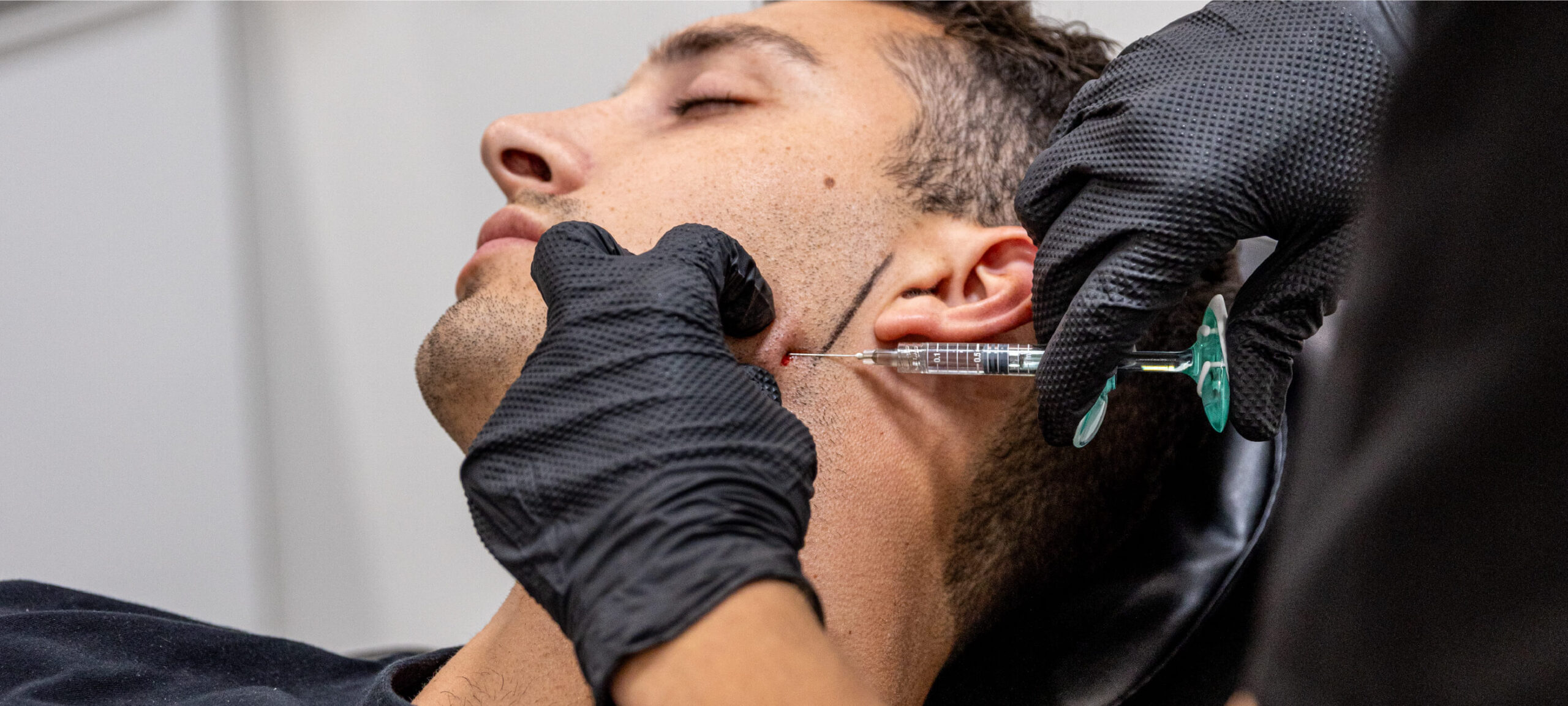 Masculinisation du visage : comment adapter les injections au visage masculin