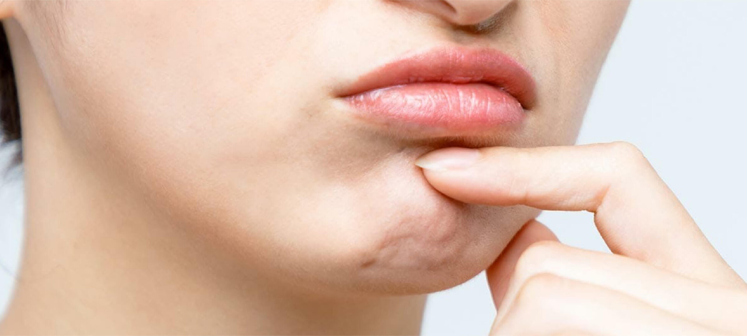 Peau d’orange au menton :corriger le menton capitonné sans chirurgie avec les neuromodulateurs