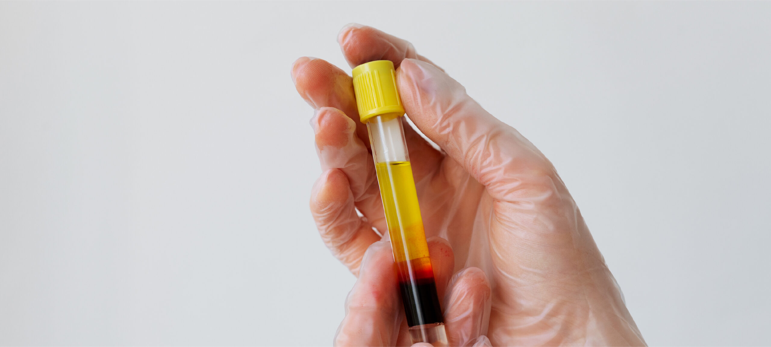 Le PRP pour la peau : un coup d’éclat 100 % naturel