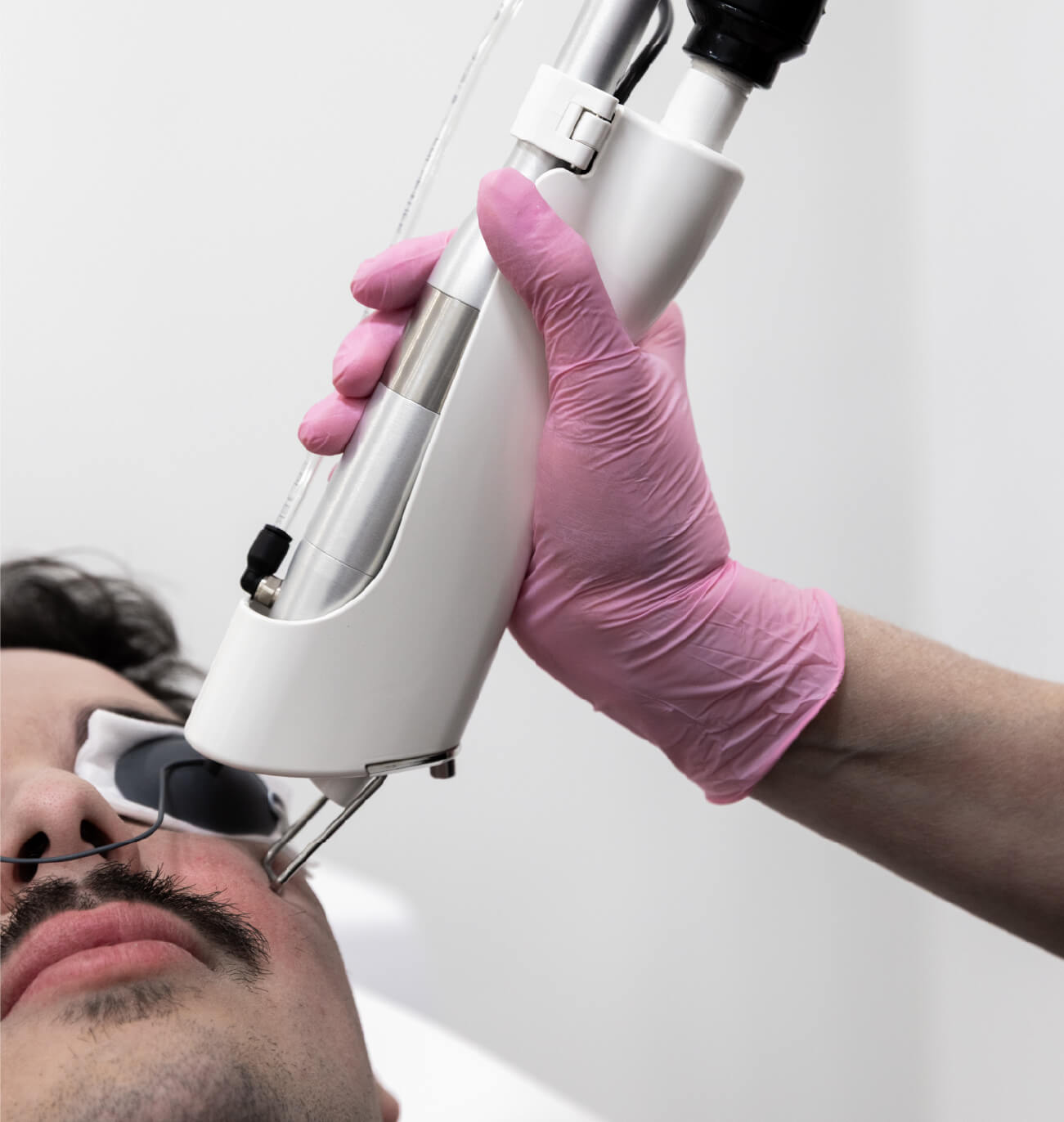 Gros plan du traitement Boost Collagène au laser Quanta appliqué sur la joue d’un homme pour raffermir la peau et stimuler la production de collagène.
