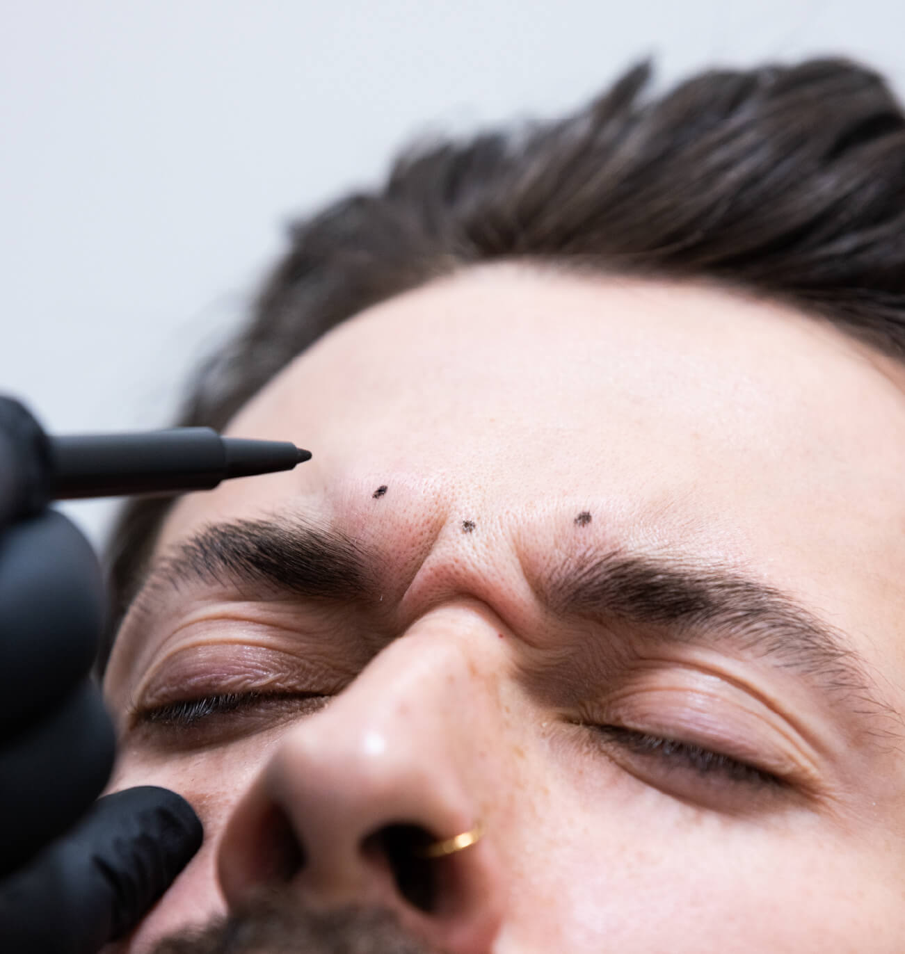 Marquage des points d’injection entre les sourcils pour un traitement Brotox visant à détendre les rides de la glabelle (rides du lion).