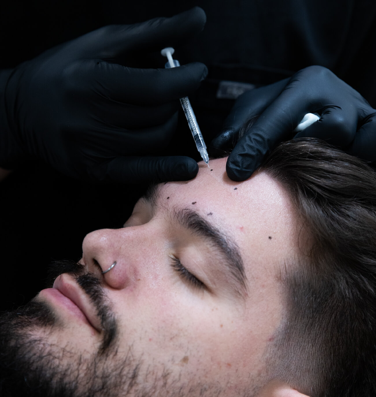 Injection de Brotox dans le front d’un homme, avec marquage des points d’injection pour lisser les rides et prévenir leur formation.