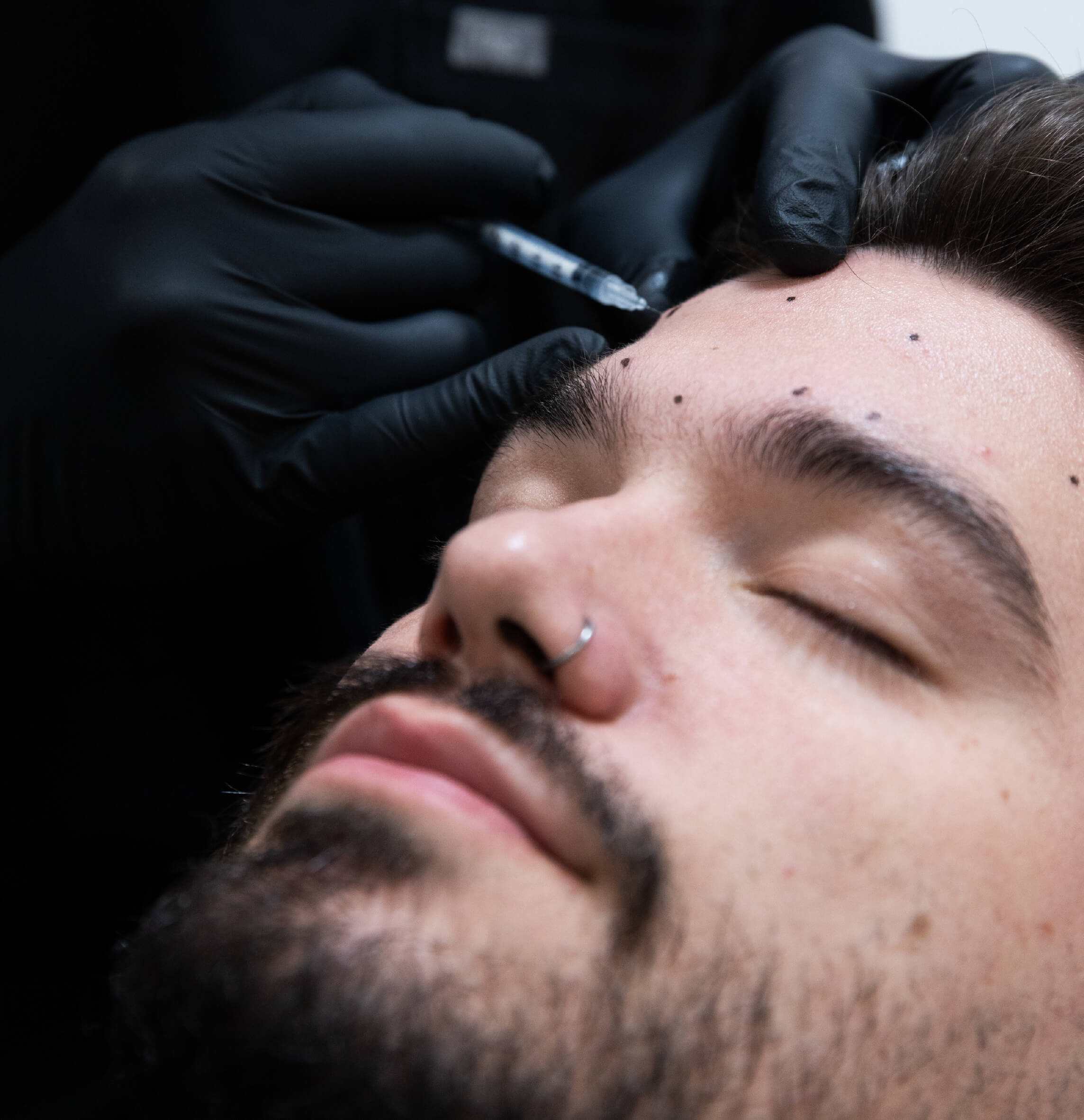 Injection de neuromodulateurs Brotox dans le front d’un homme avec points de repère marqués pour cibler les rides d’expression.