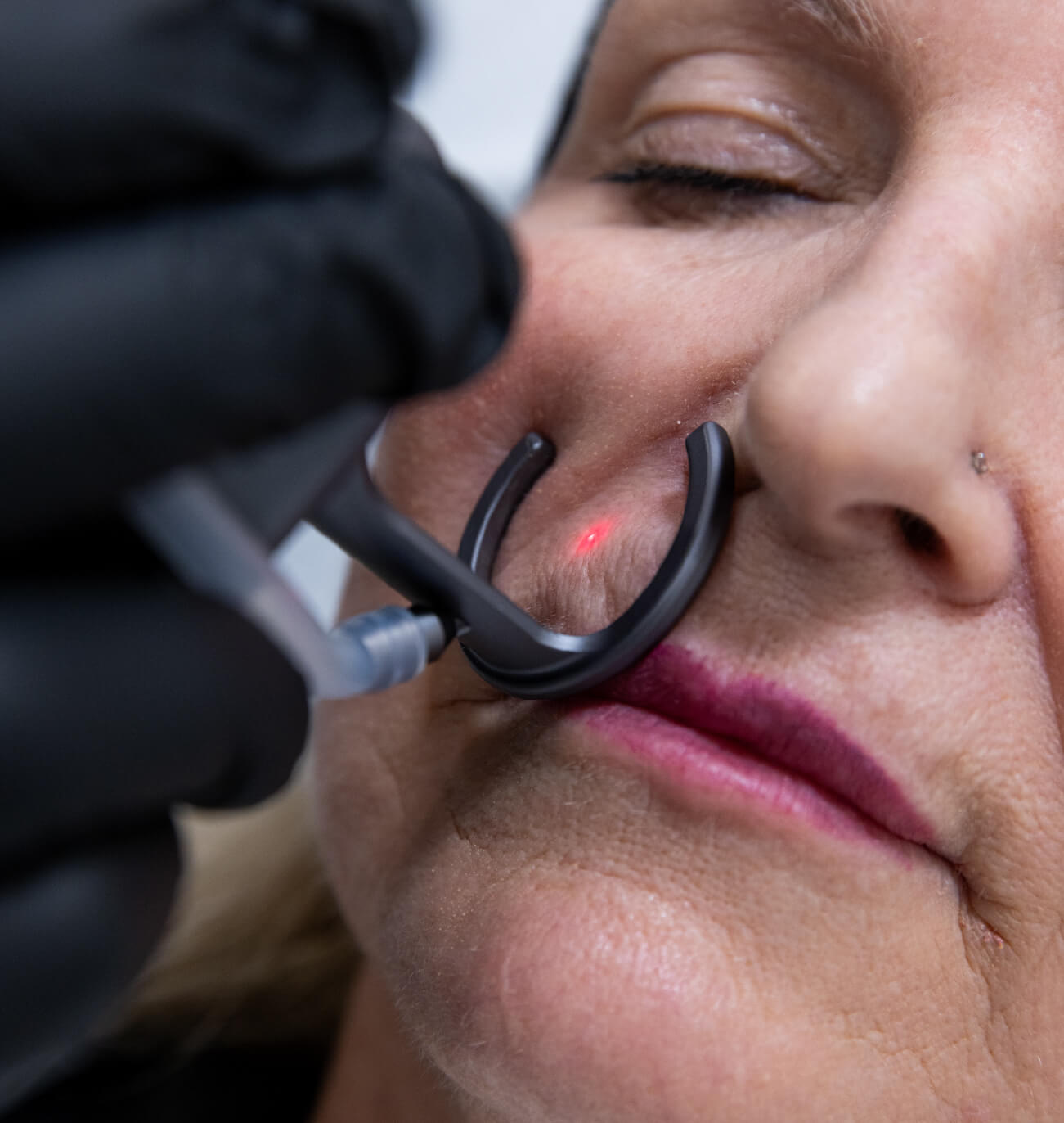 Gros plan d’un traitement au laser CO2 sur la lèvre supérieure pour améliorer la texture de la peau et réduire les ridules péribuccales.