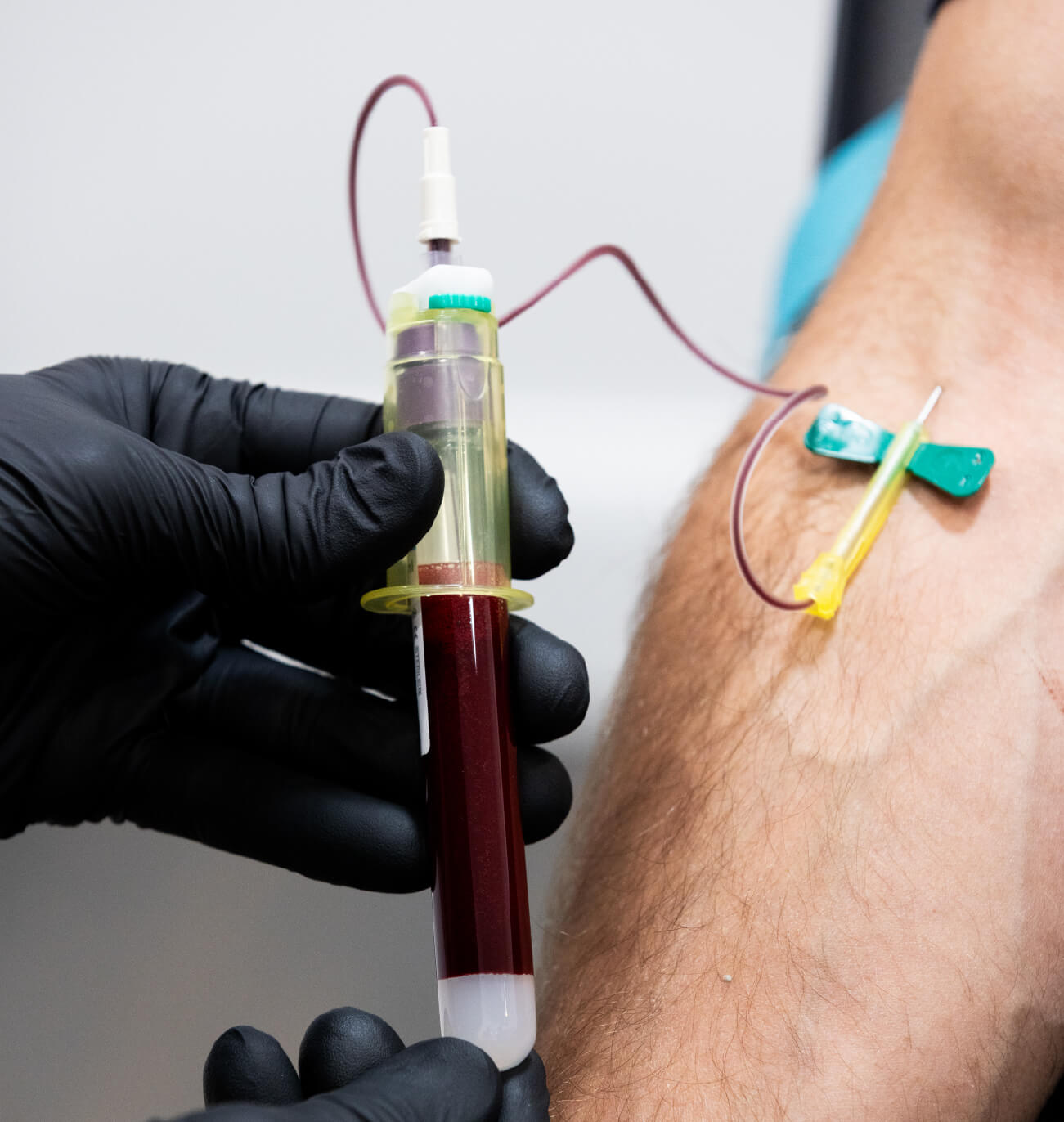 Prélèvement sanguin effectué en clinique médico-esthétique à l’aide d’un papillon et d’un tube pour la préparation de PRP ou PRF