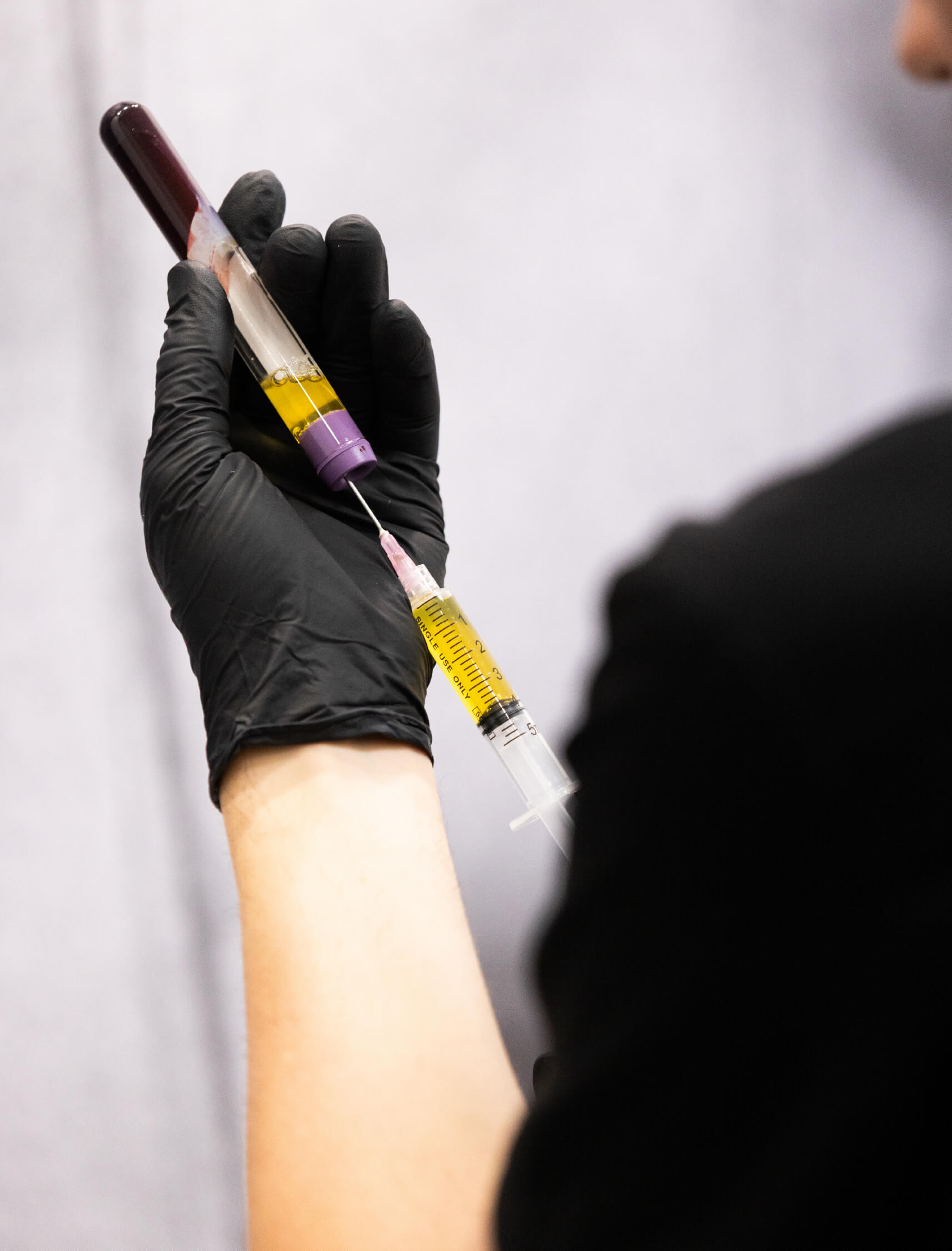 Préparation d’une injection de plasma riche en fibrine (PRF) à partir d’un tube de sang centrifugé