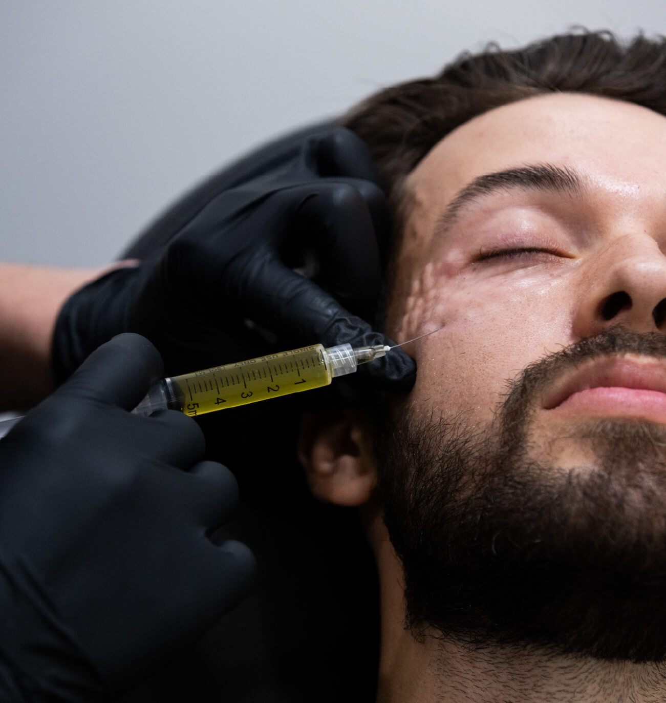Injection de plasma riche en fibrine (PRF) dans les cernes avec la technique CernesBoosters Ultra chez un homme