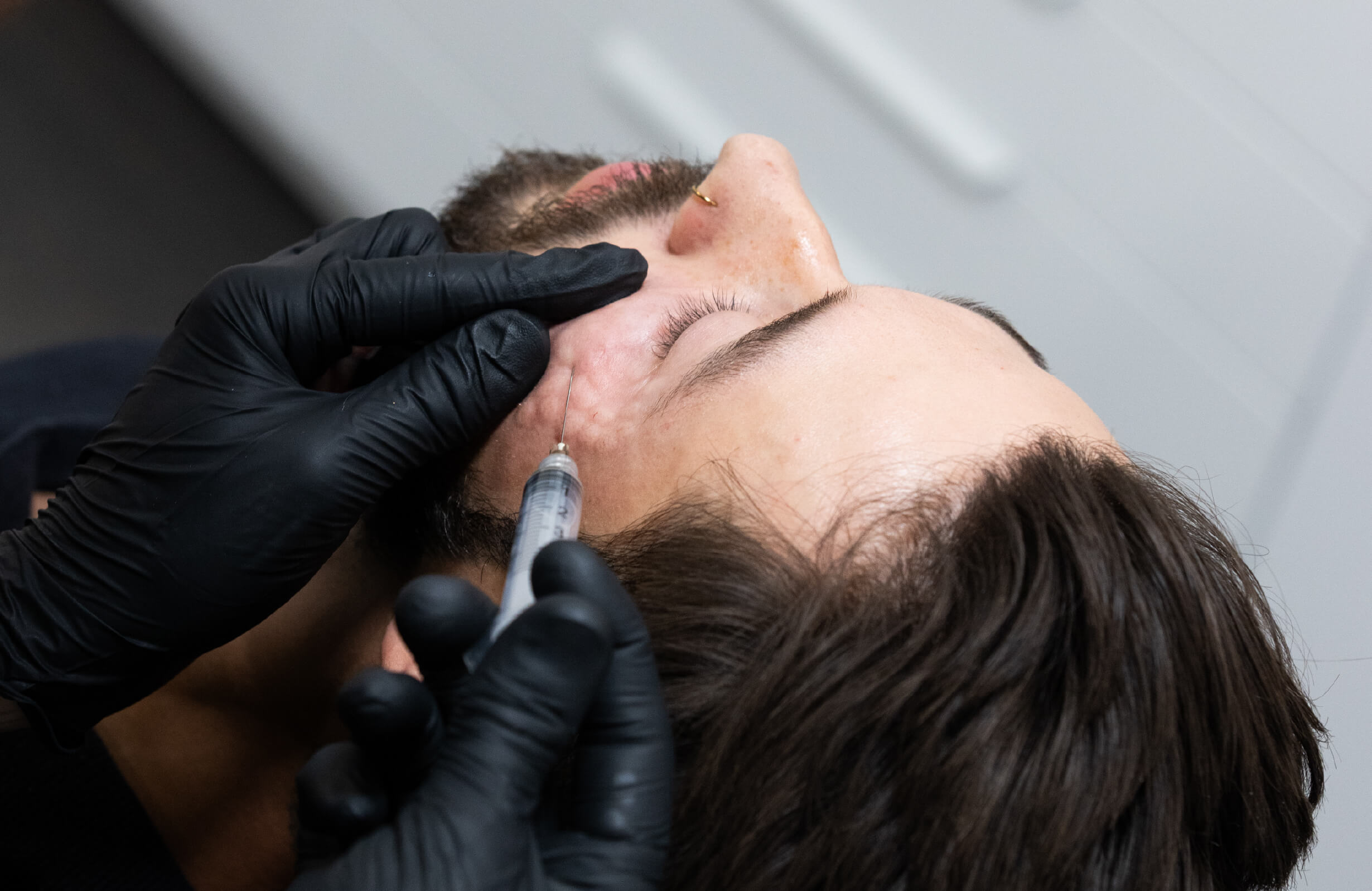 Injection de plasma riche en fibrine (PRF) dans les cernes avec la technique CernesBoosters Ultra chez un homme