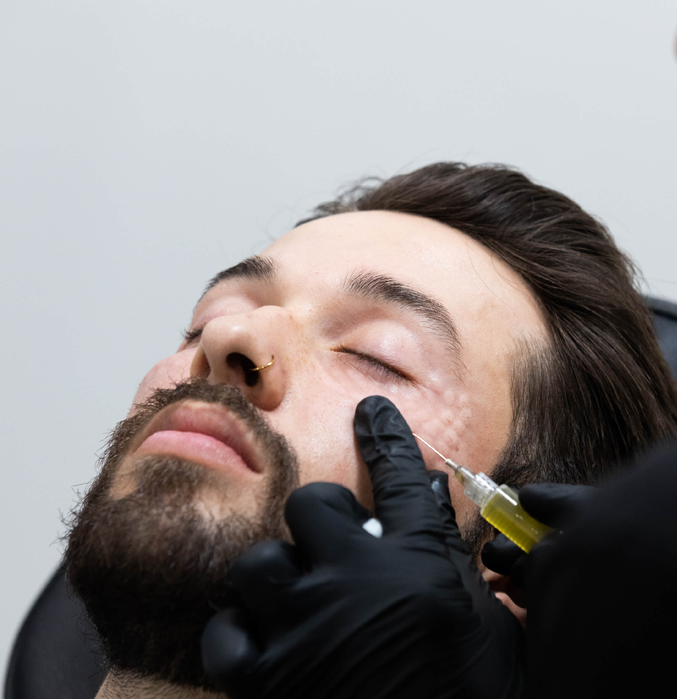 Injection de plasma riche en fibrine (PRF) dans les cernes avec la technique CernesBoosters Ultra chez un homme