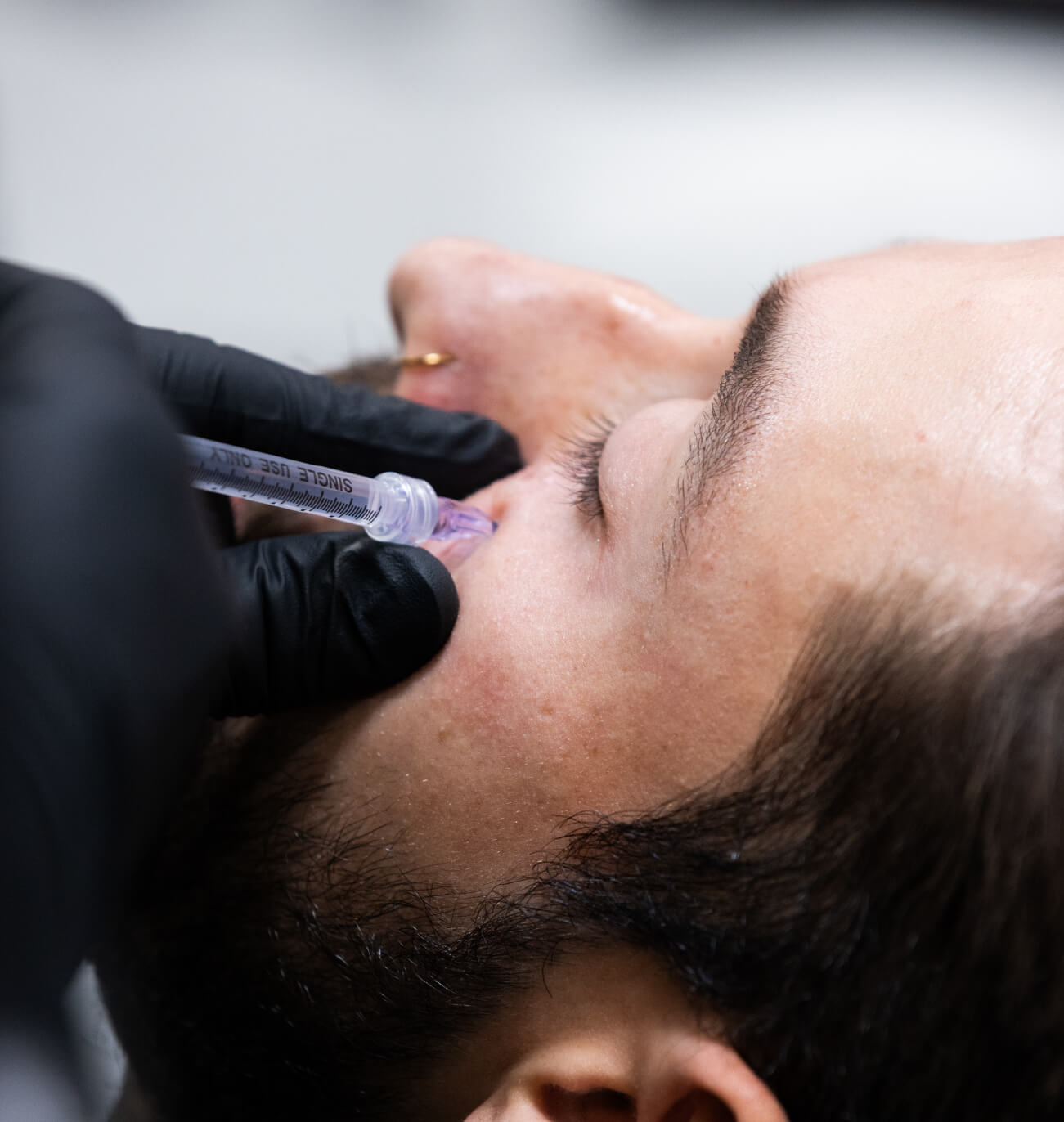 Injection CernesBoosters d’un homme pour réduire l’apparence des cernes et améliorer l’éclat du regard.