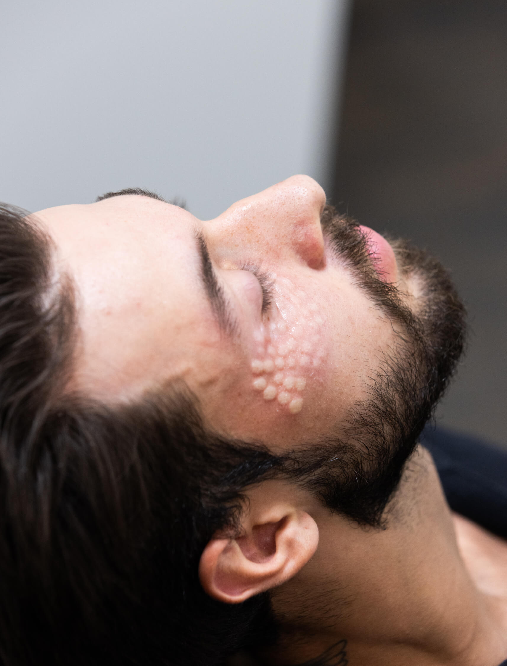 Résultat immédiat après l’injection CernesBoosters montrant les micro-papules sous l’œil, typiques du traitement avec plasma riche en fibrine (PRF).