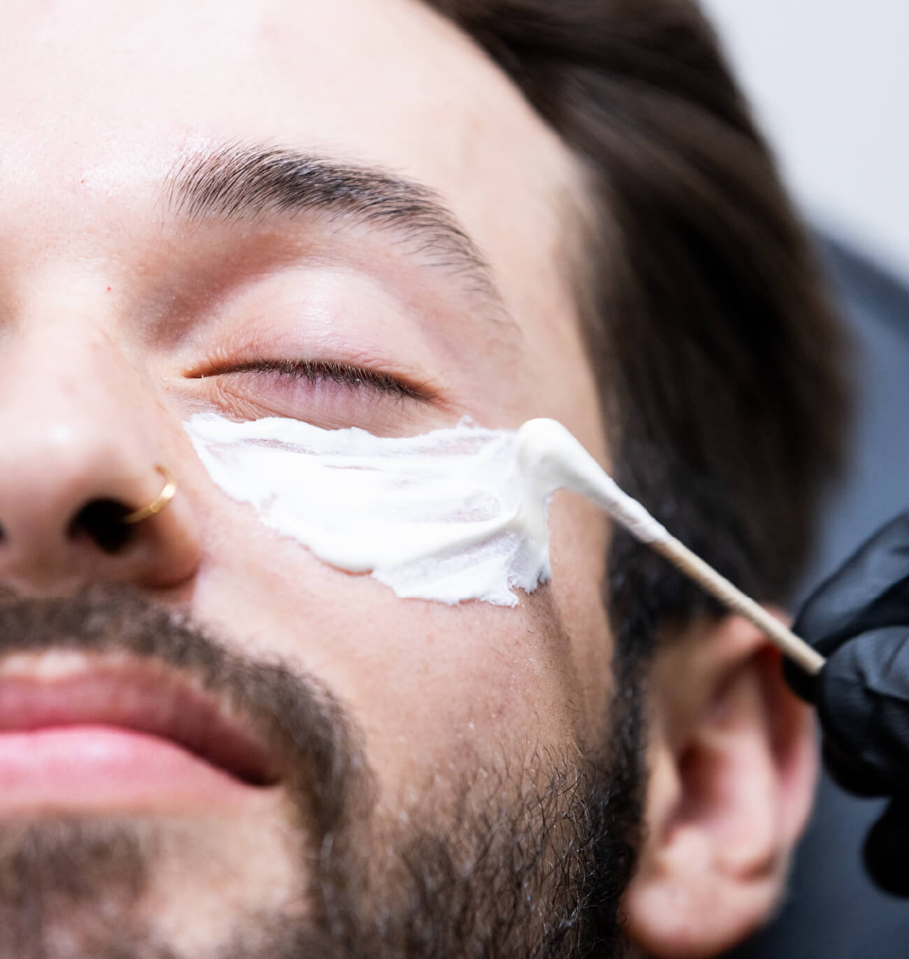 Application d’une crème anesthésiante sous les yeux d’un homme avant un traitement CernesBoosters pour réduire l’inconfort lors de l’injection.
