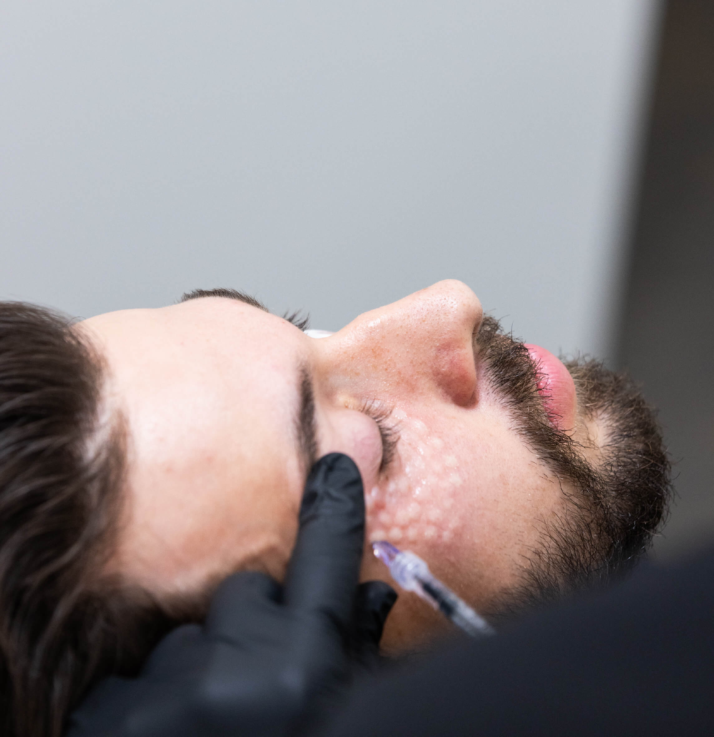 Injection CernesBoosters d’un homme pour réduire l’apparence des cernes et améliorer l’éclat du regard.