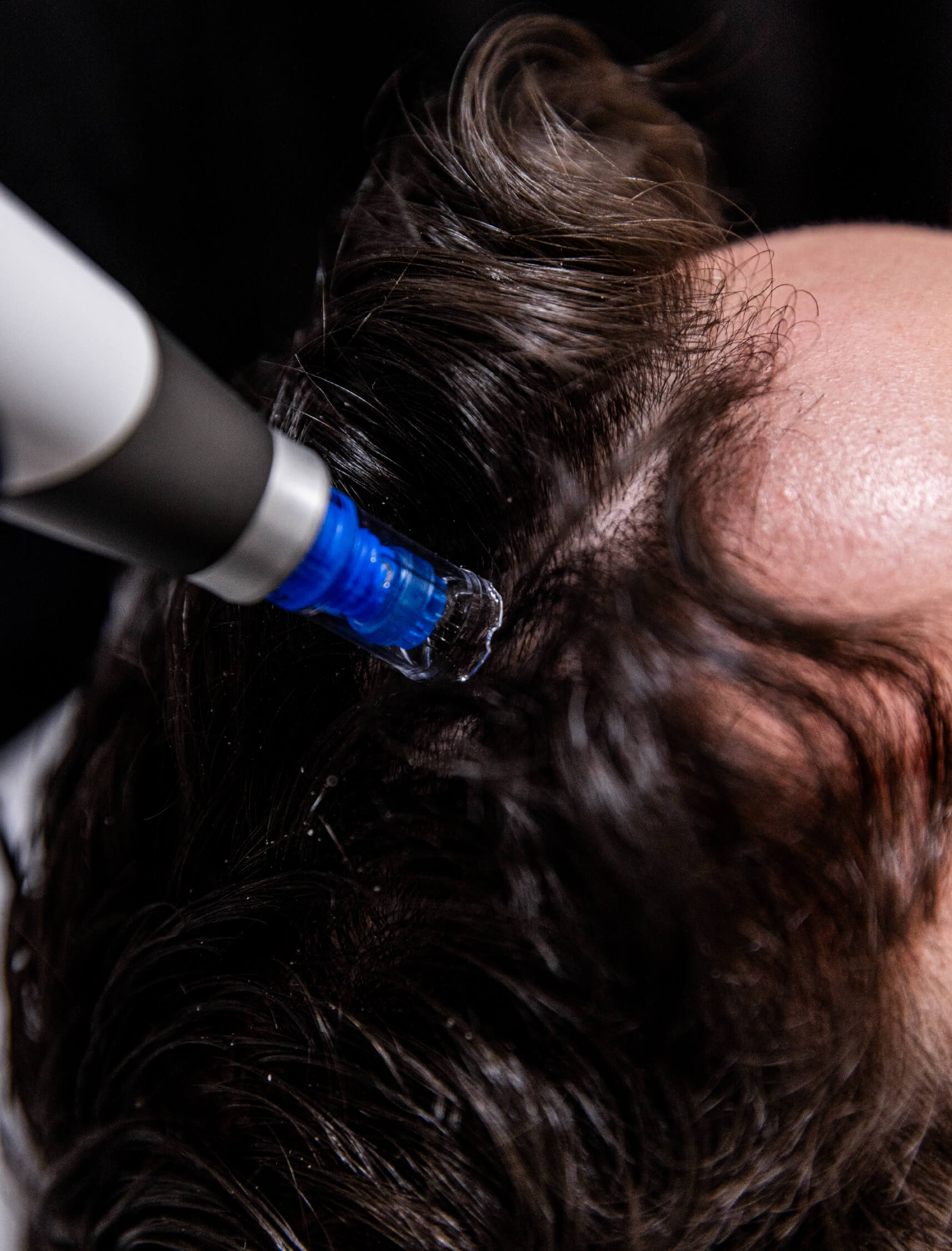 Application d’exosomes sur le cuir chevelu à l’aide du Dermapen 4 pour stimuler la repousse des cheveux dans une zone dégarnie.