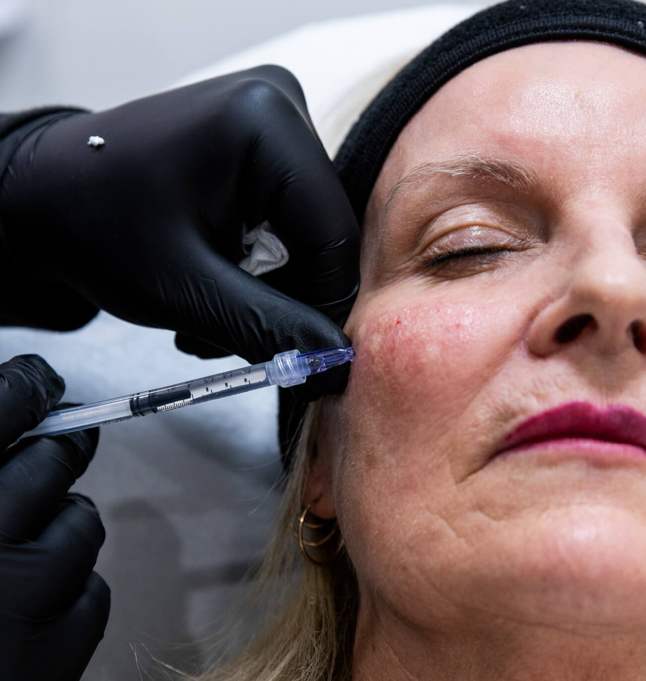 Injection de microtox dans la joue d’une femme pour lisser les ridules et raffermir la peau.