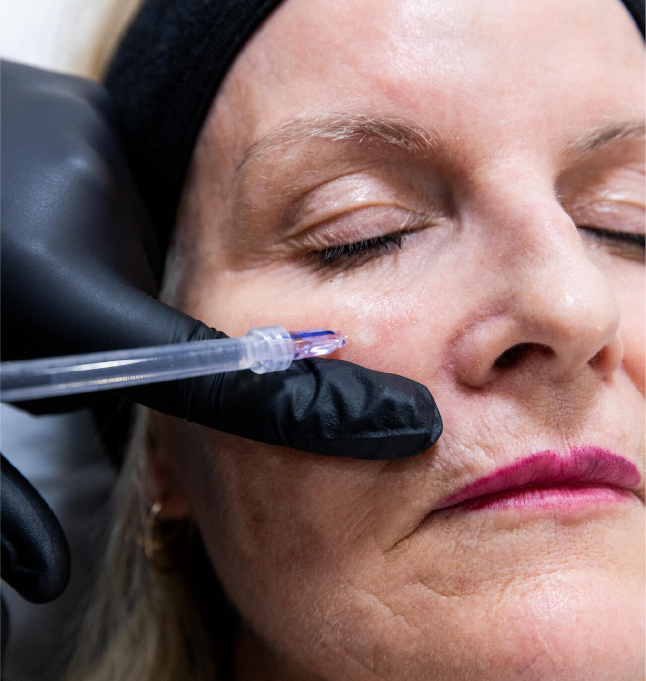 Aiguille en position pour une injection dans la joue d’une femme en clinique médico-esthétique.