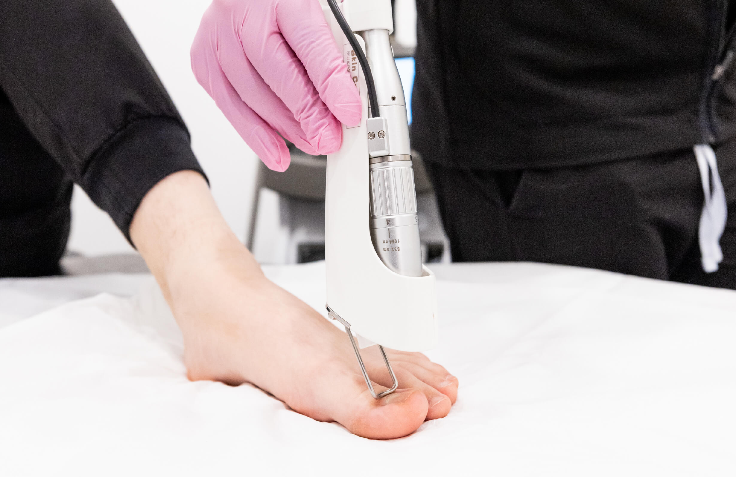 Traitement au laser Quanta d’une mycose de l’ongle du pied pour éliminer une infection fongique efficacement et sans douleur.
