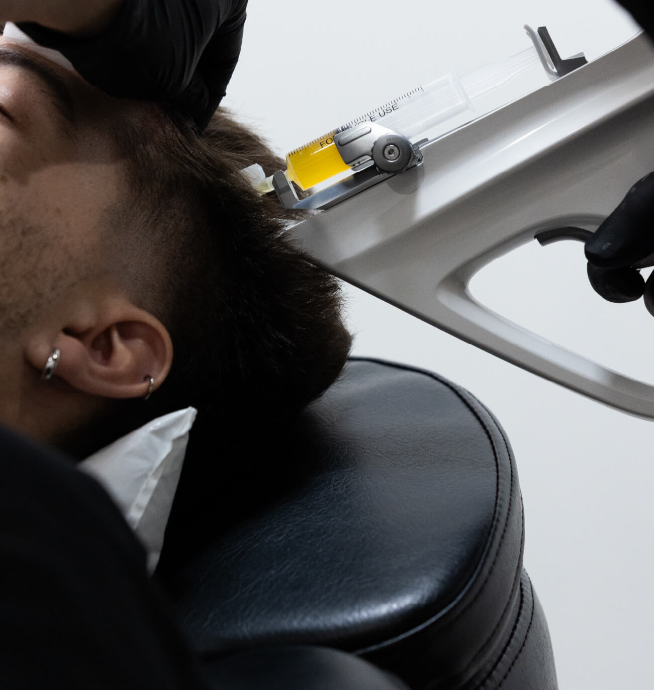 Injection de PRP (plasma riche en plaquettes) dans le cuir chevelu d’un homme pour stimuler la repousse des cheveux et renforcer les follicules capillaires.