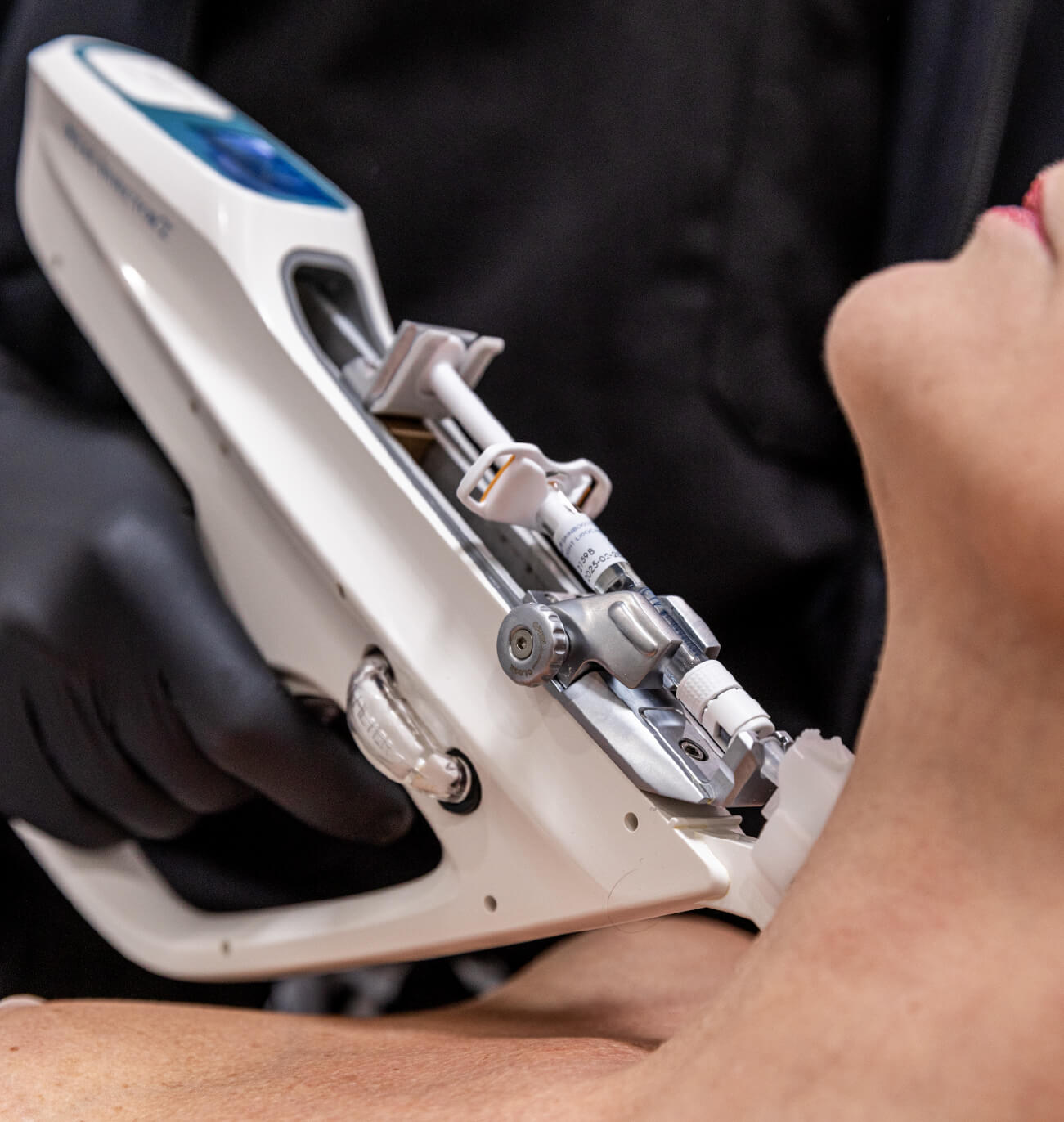Injection de Skinboosters au niveau du cou à l’aide d’un injecteur multi-aiguilles pour hydrater et revitaliser la peau en profondeur.