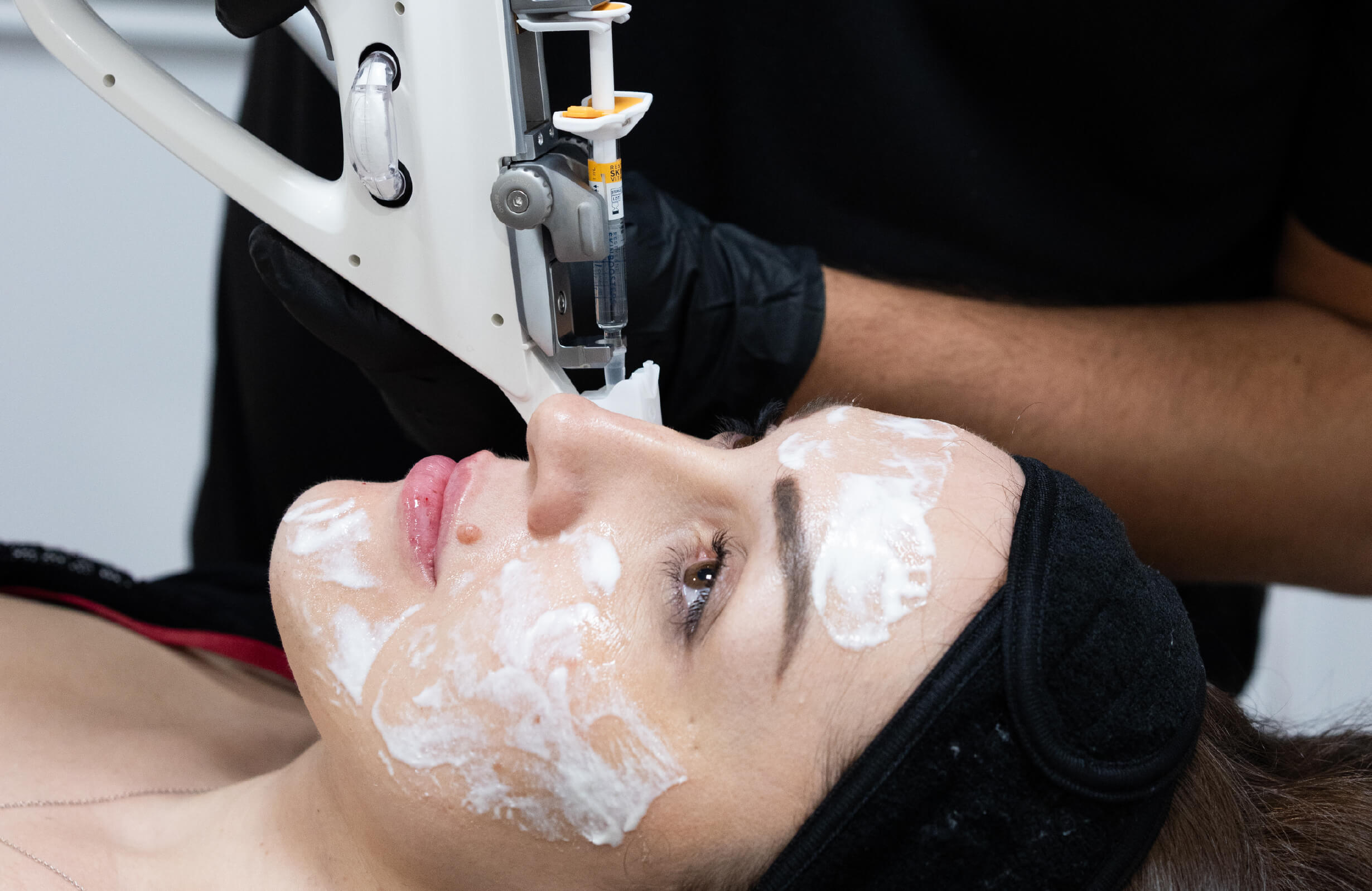 Application de Skinboosters à l’aide d’un injecteur multi-aiguilles sur le visage d’une femme, avec crème anesthésiante appliquée en pré-traitement.