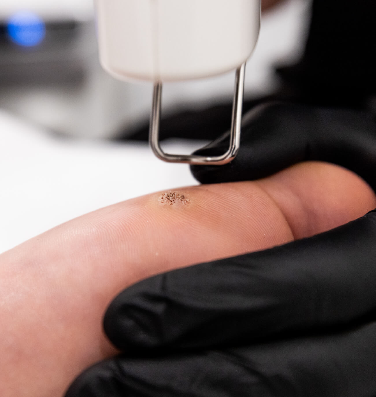 Élimination d’une verrue plantaire au laser Quanta sur un orteil, réalisée en clinique médico-esthétique par un professionnel portant des gants noirs.