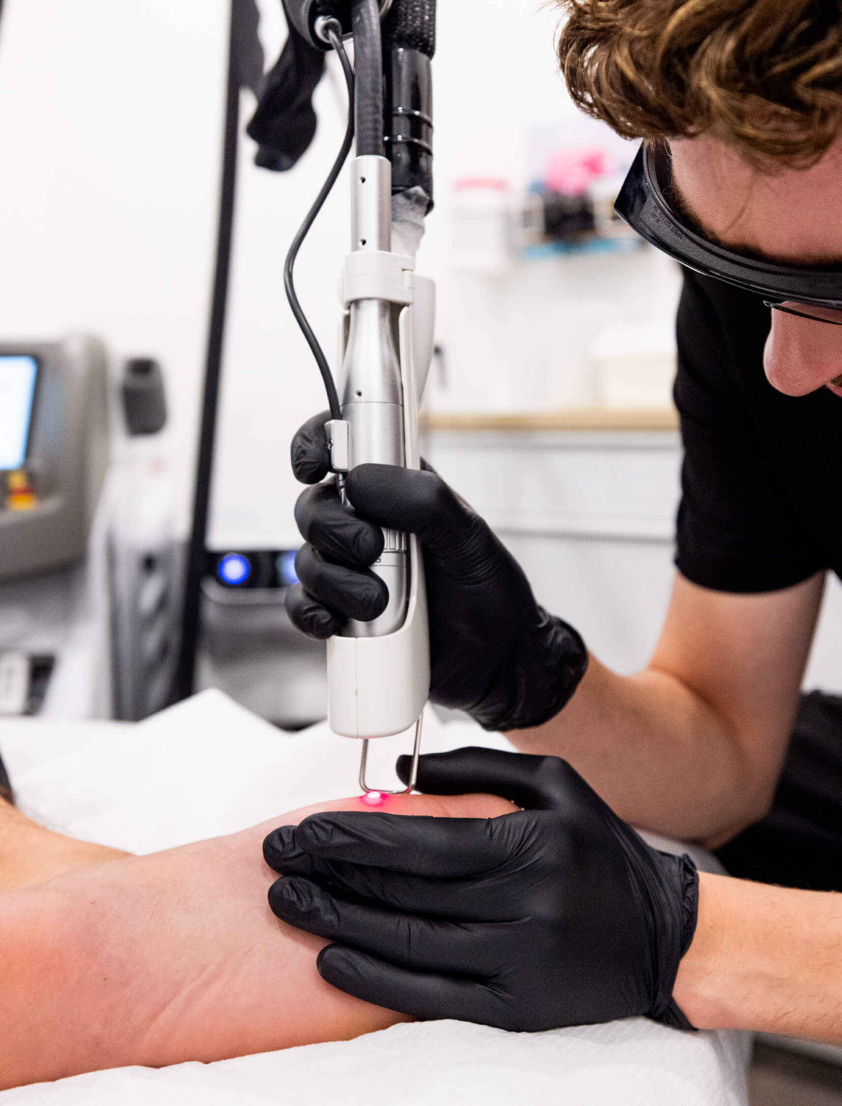 Traitement d’une verrue plantaire au laser Quanta sur le pied, réalisé en clinique médico-esthétique par un professionnel portant des gants noirs et des lunettes de protection.