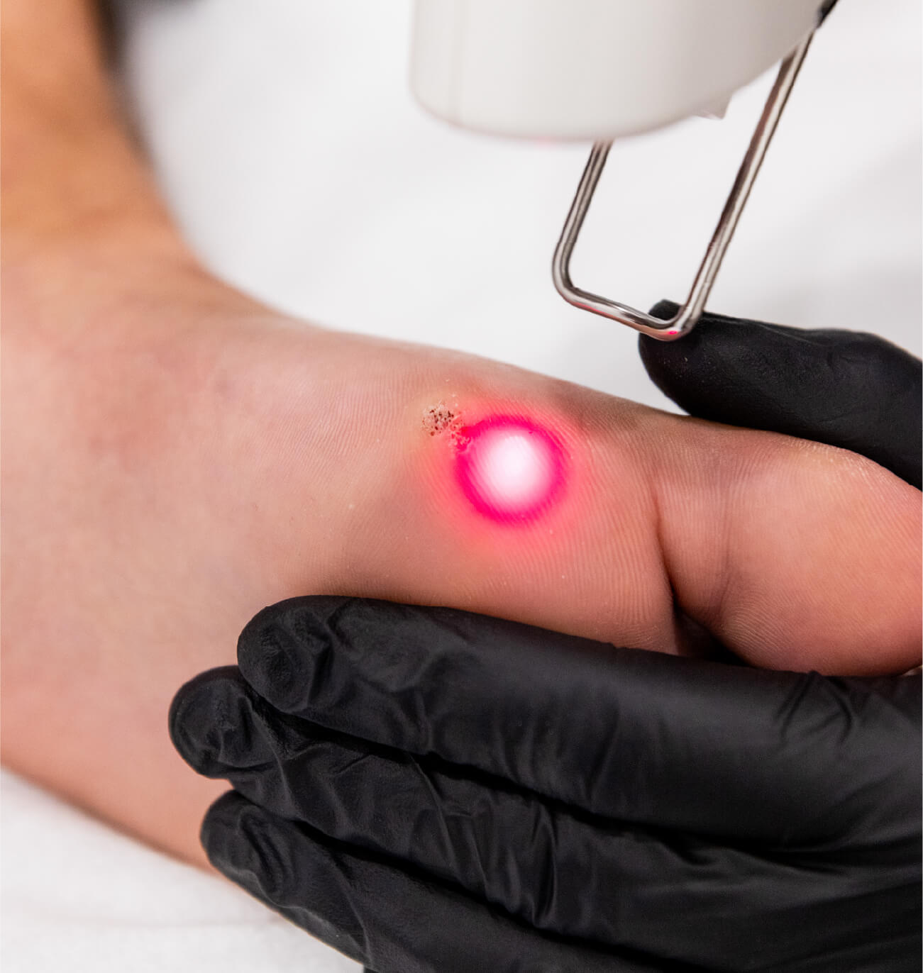 Élimination d’une verrue plantaire au laser Quanta sur un orteil, réalisée en clinique médico-esthétique par un professionnel portant des gants noirs.