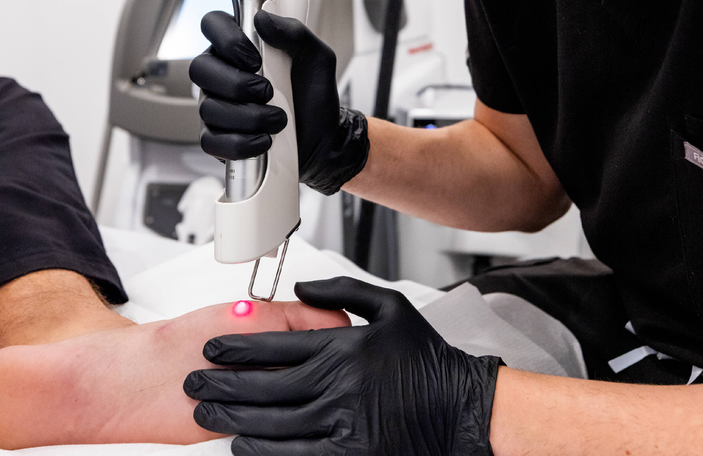 Traitement d’une verrue plantaire au laser Quanta effectué sur un orteil en clinique médico-esthétique par un professionnel portant des gants noirs.