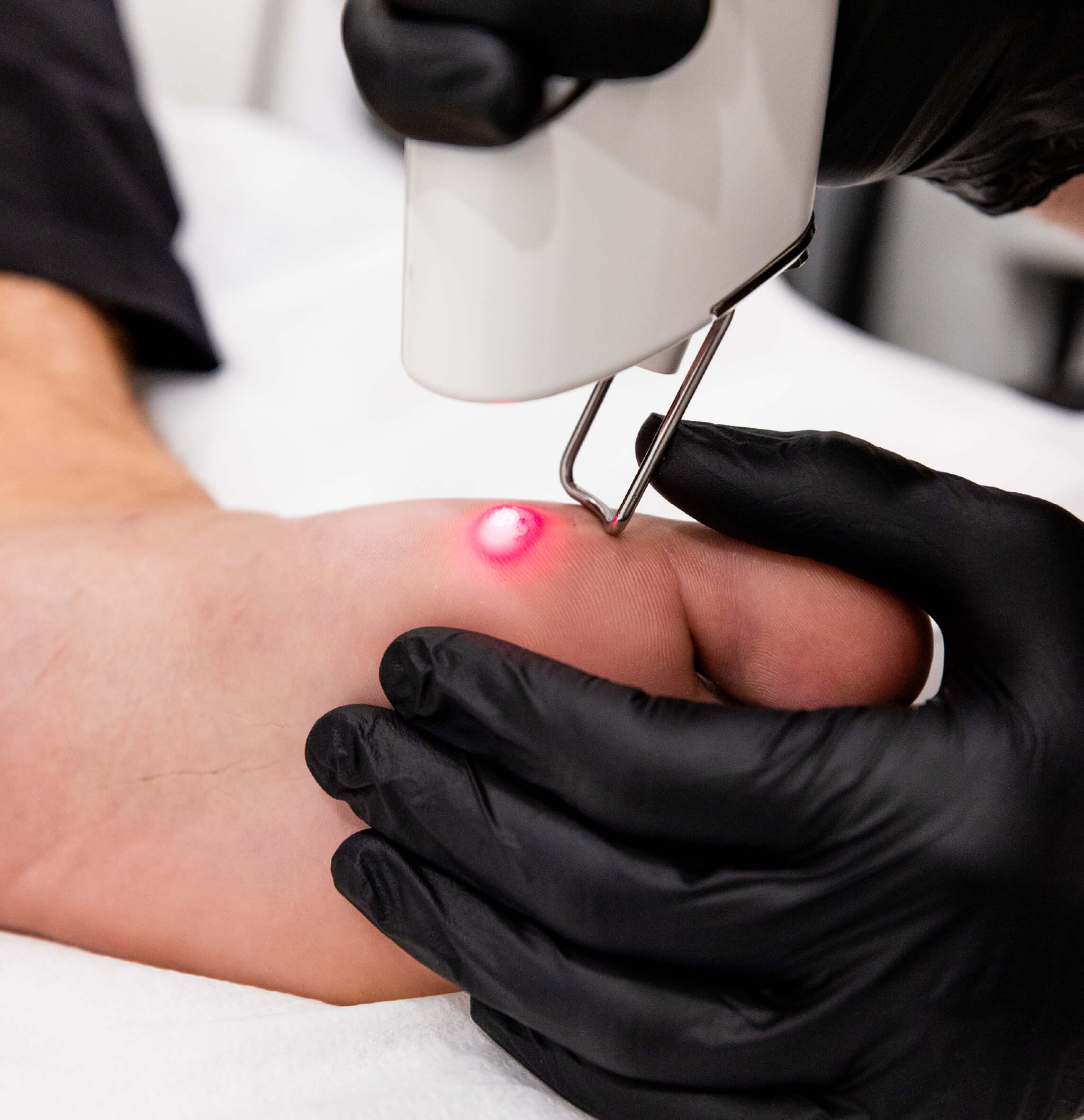 Élimination d’une verrue plantaire au laser Quanta sur un orteil, réalisée en clinique médico-esthétique par un professionnel portant des gants noirs.