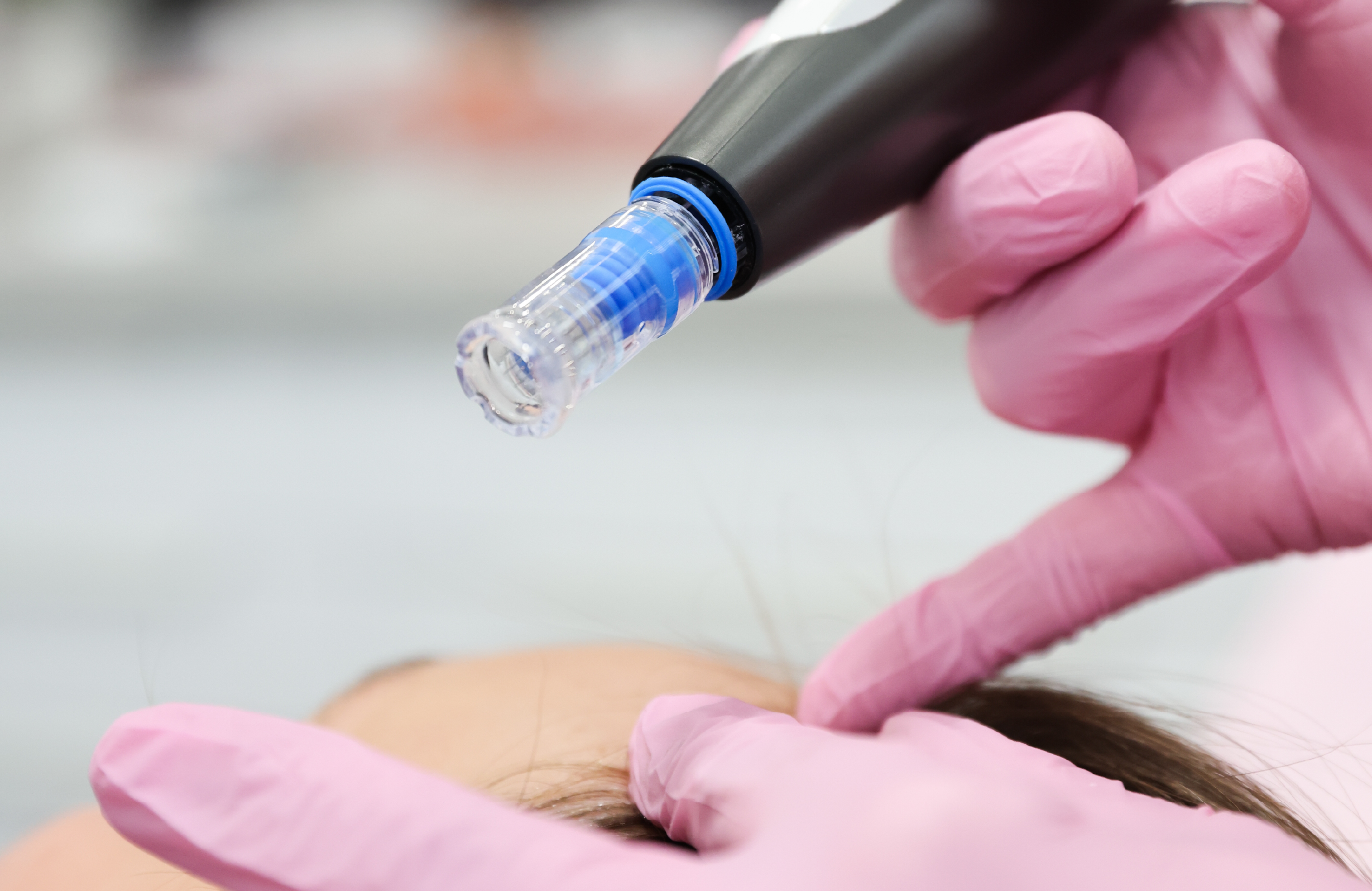 Appareil utilisé pour appliquer un traitement aux exosomes sur le cuir chevelu