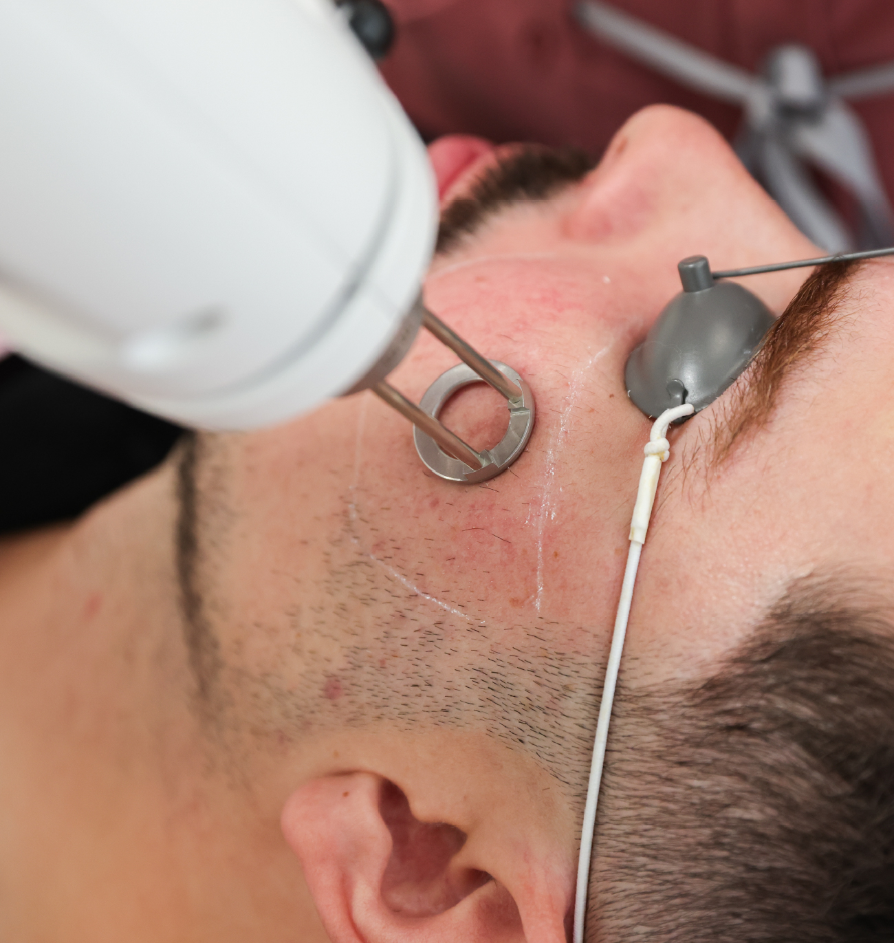 Traitement au laser Erbium appliqué sur la joue d’un patient