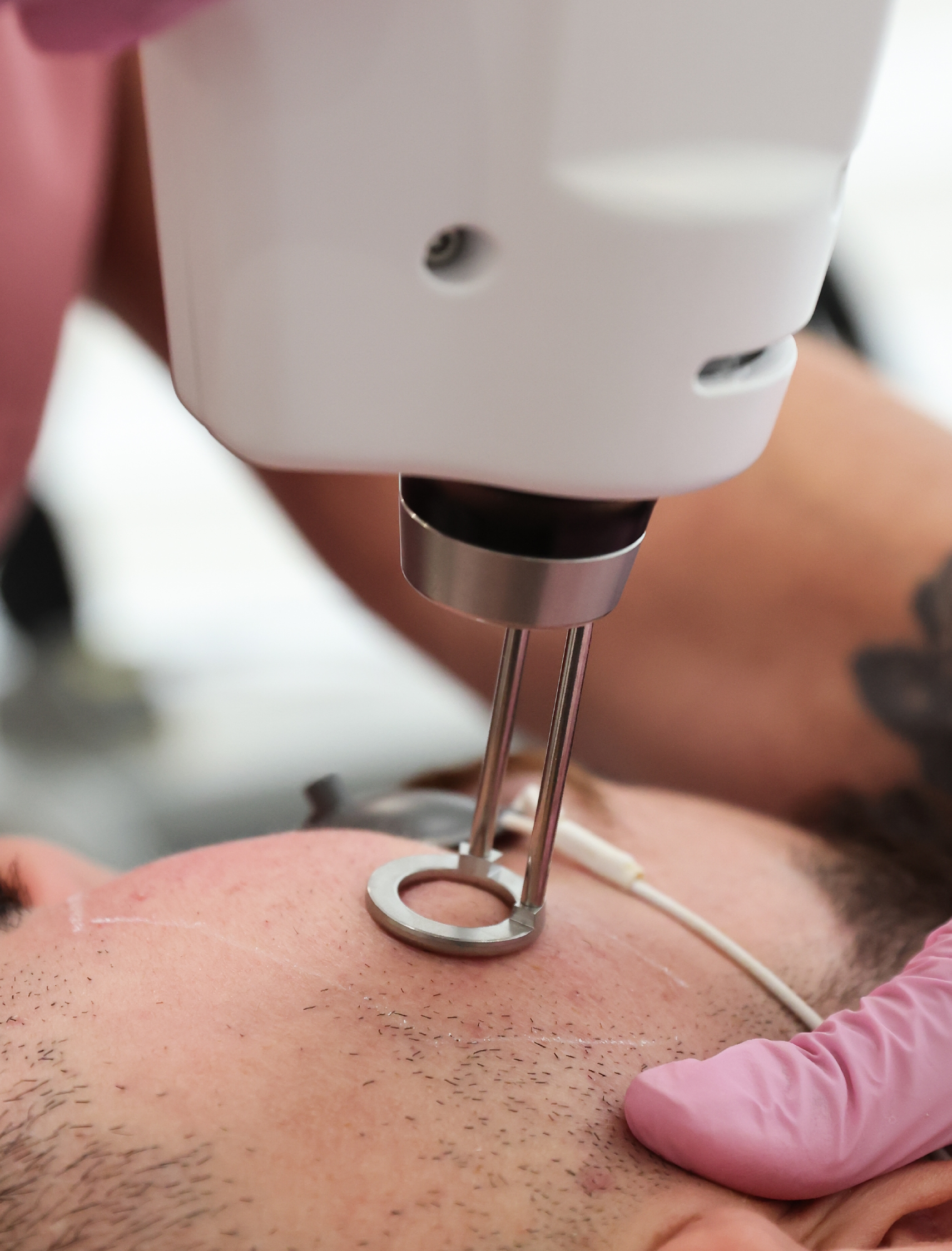 Appareil de laser Erbium appliqué sur la peau du visage d’un patient