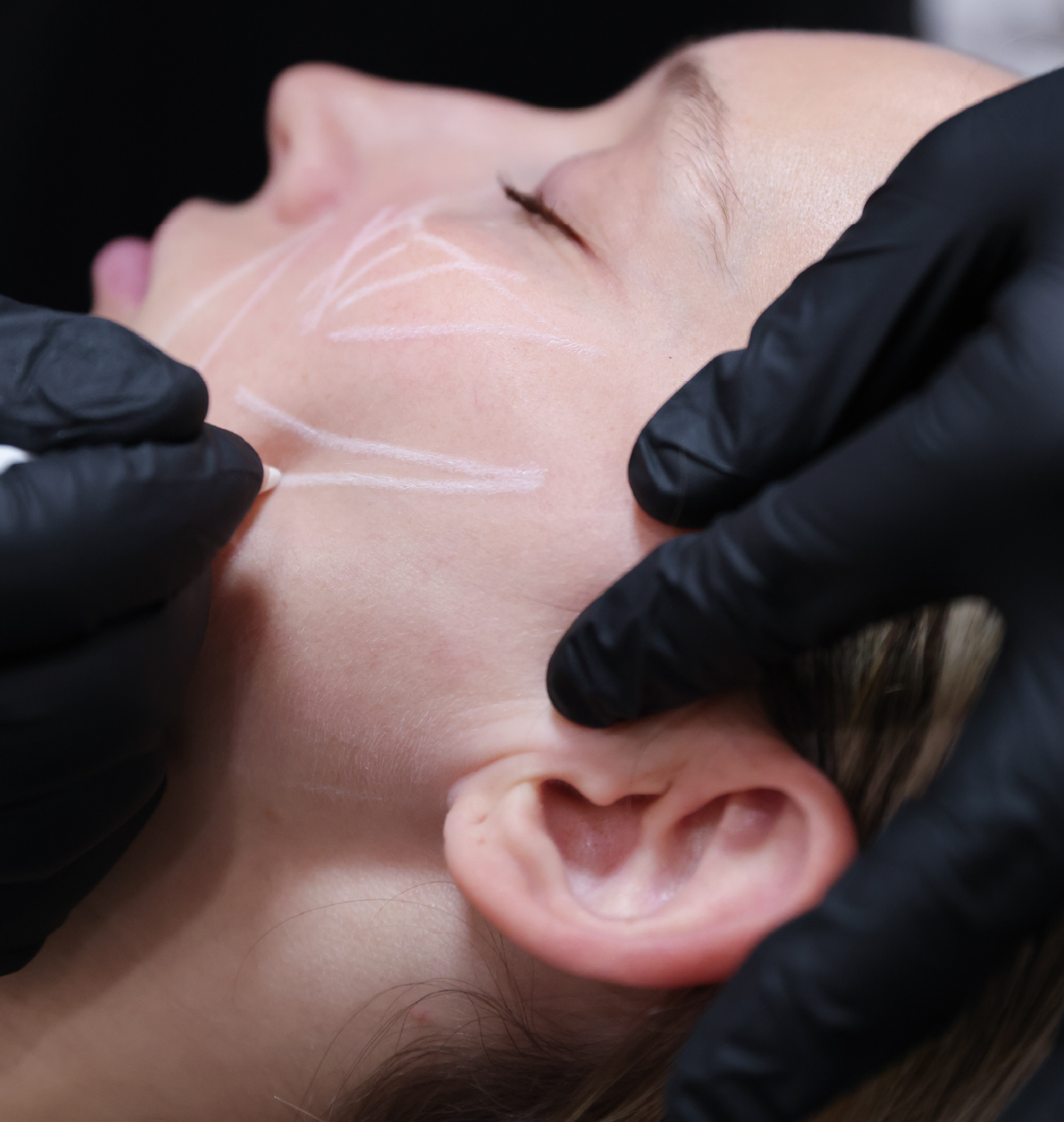 Gros plan sur une séance de PRF Gel avec le visage d’une patiente marqué de repères blancs pour guider le traitement esthétique.