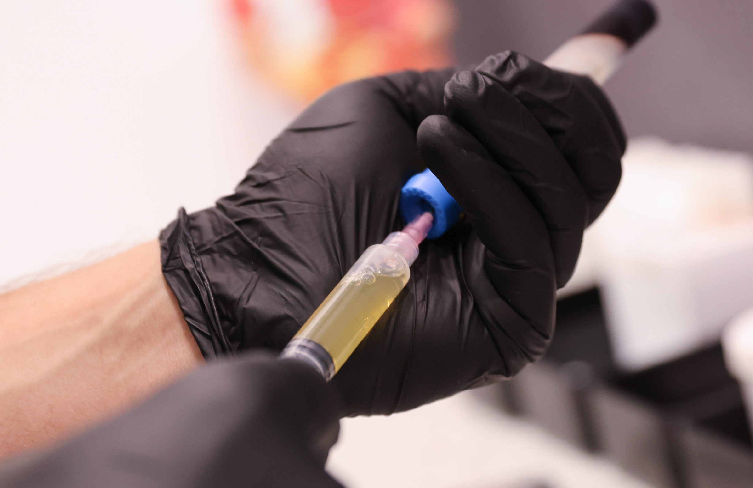 Injection de PRF Gel réalisée à l’aide d’une seringue contenant un liquide doré, lors d’un traitement de médecine esthétique.