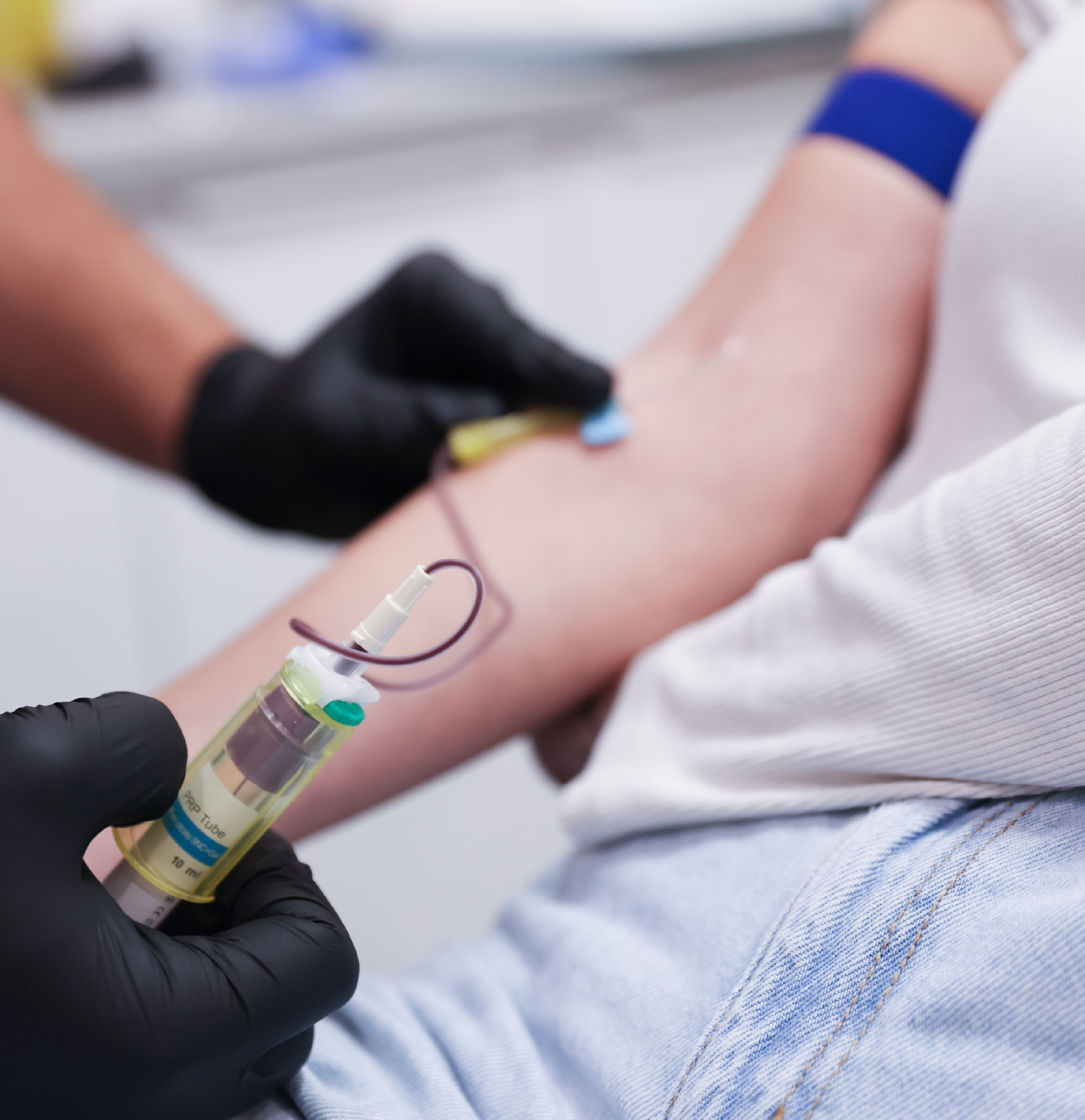Gros plan sur un prélèvement sanguin réalisé dans le cadre d’un traitement de PRF Gel, avec un tube de prélèvement tenu par un professionnel portant des gants noirs.
