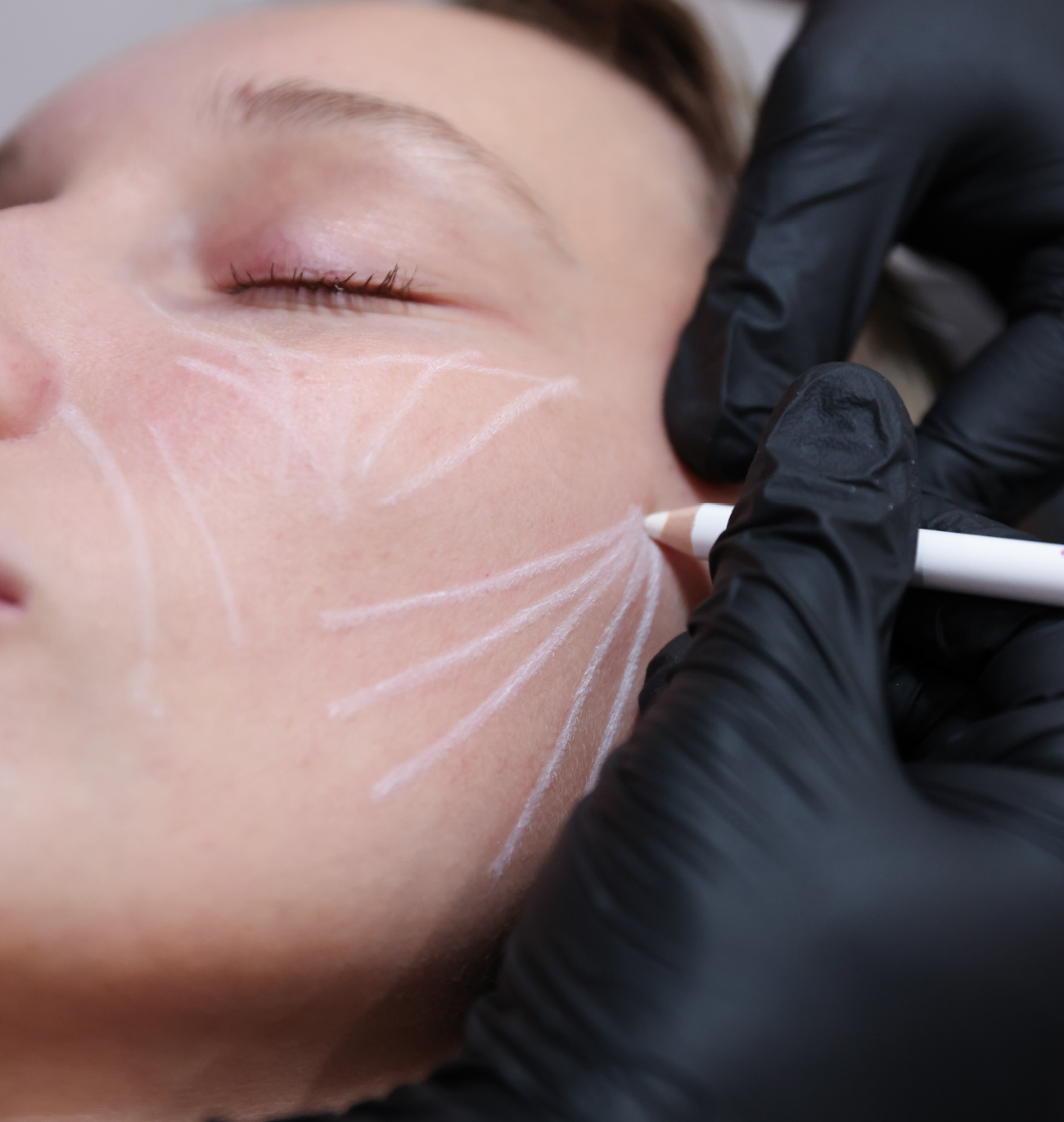 Visage d’une patiente avec des lignes de marquage sur la joue pendant une consultation en médecine esthétique.