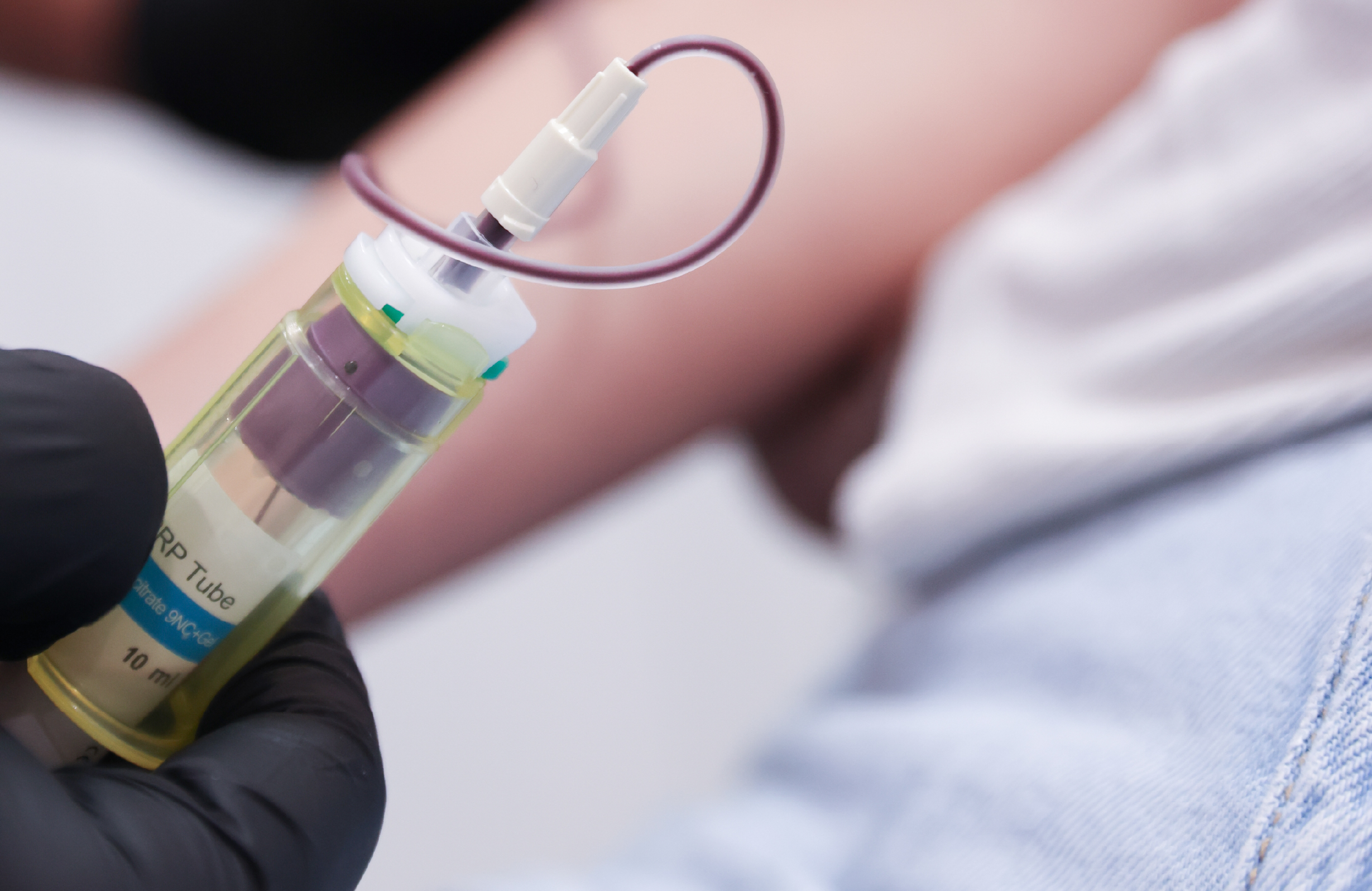 Tube de PRP utilisé dans le cadre d’un traitement de PRP Gel en médecine esthétique.