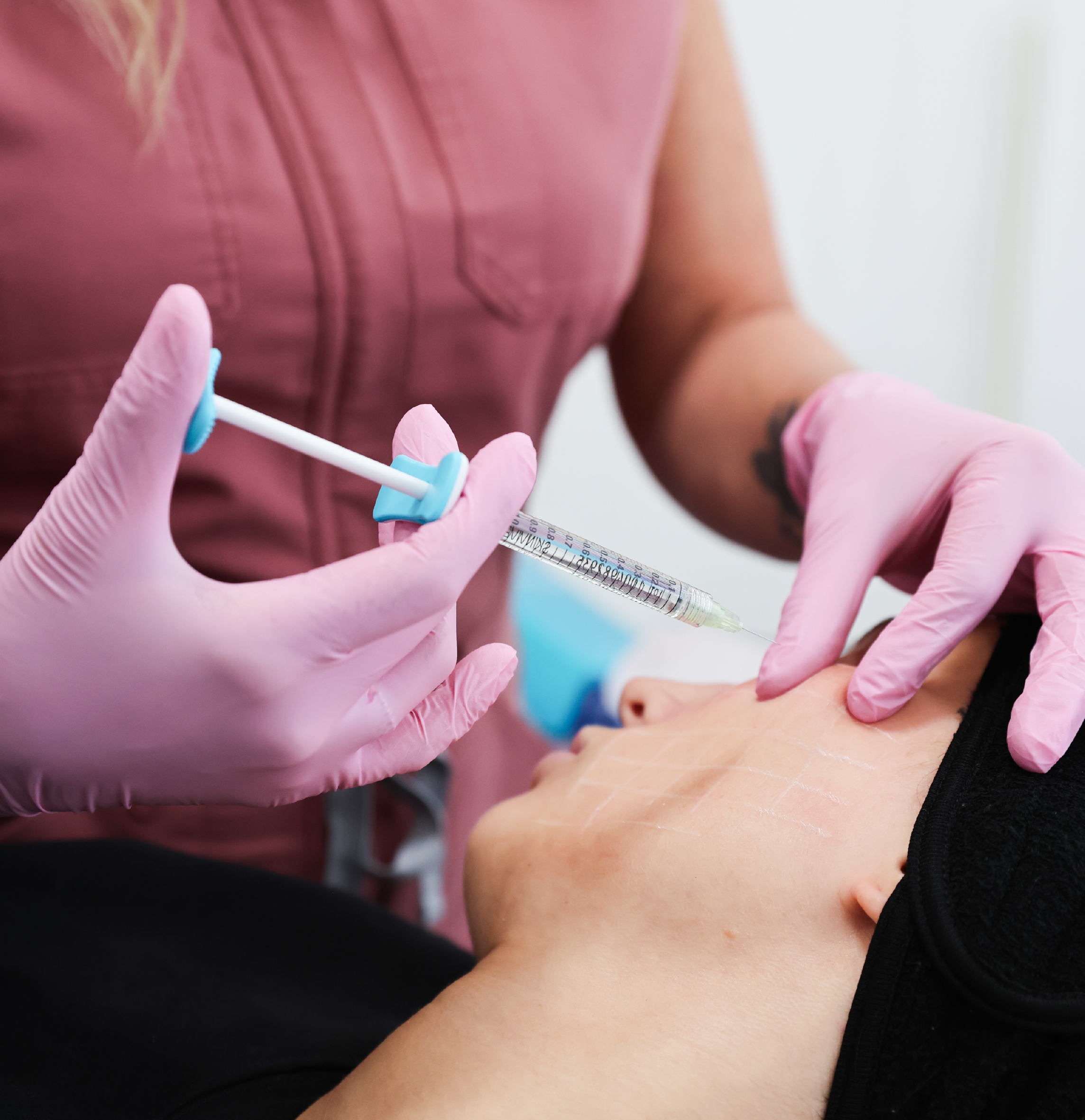 Seringue utilisée pour la préparation d’un traitement Skinvive, tenue par un professionnel de la santé portant des gants roses.